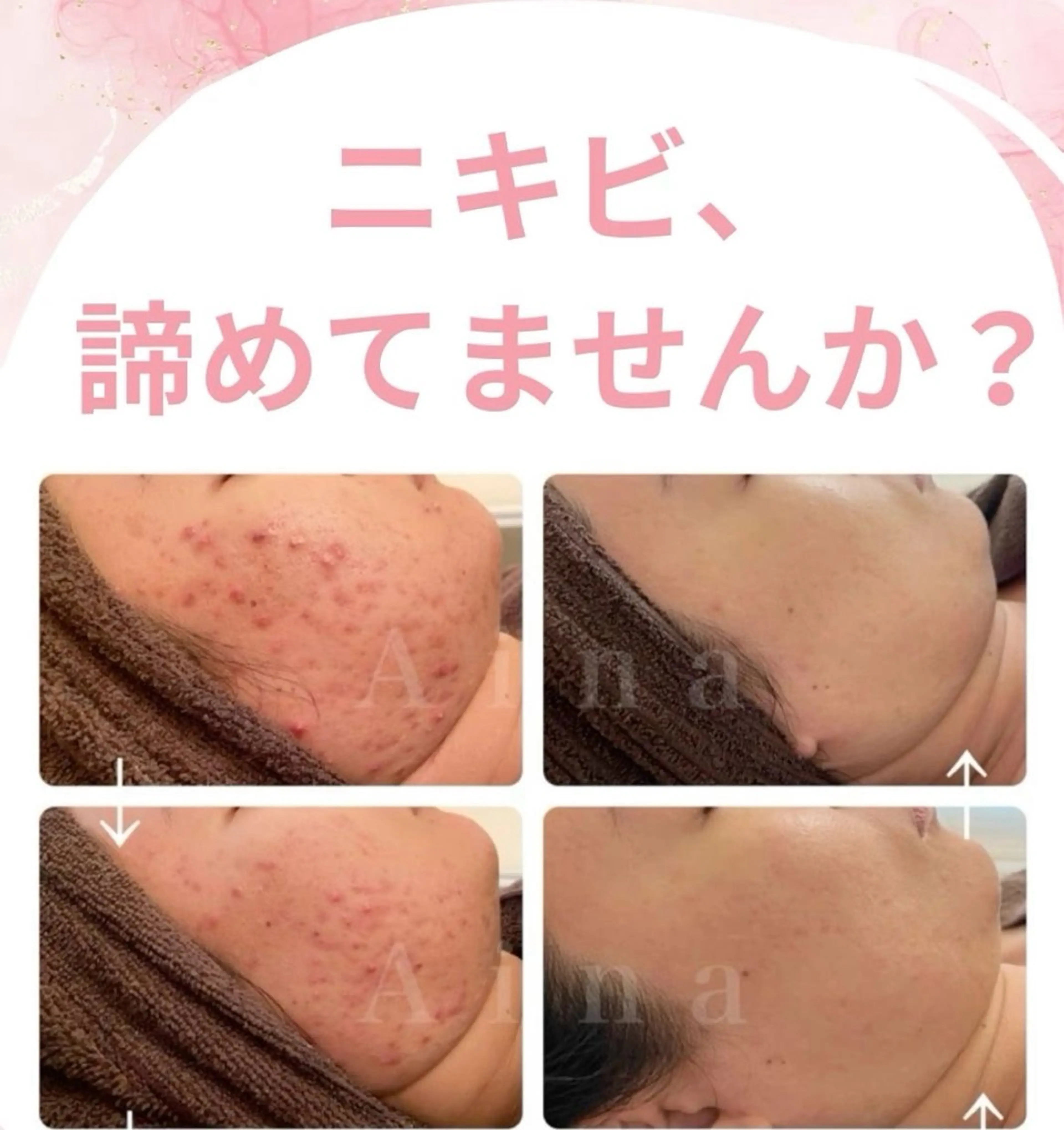 最新毛穴洗浄！美肌洗顔！リフトアップ！の写真