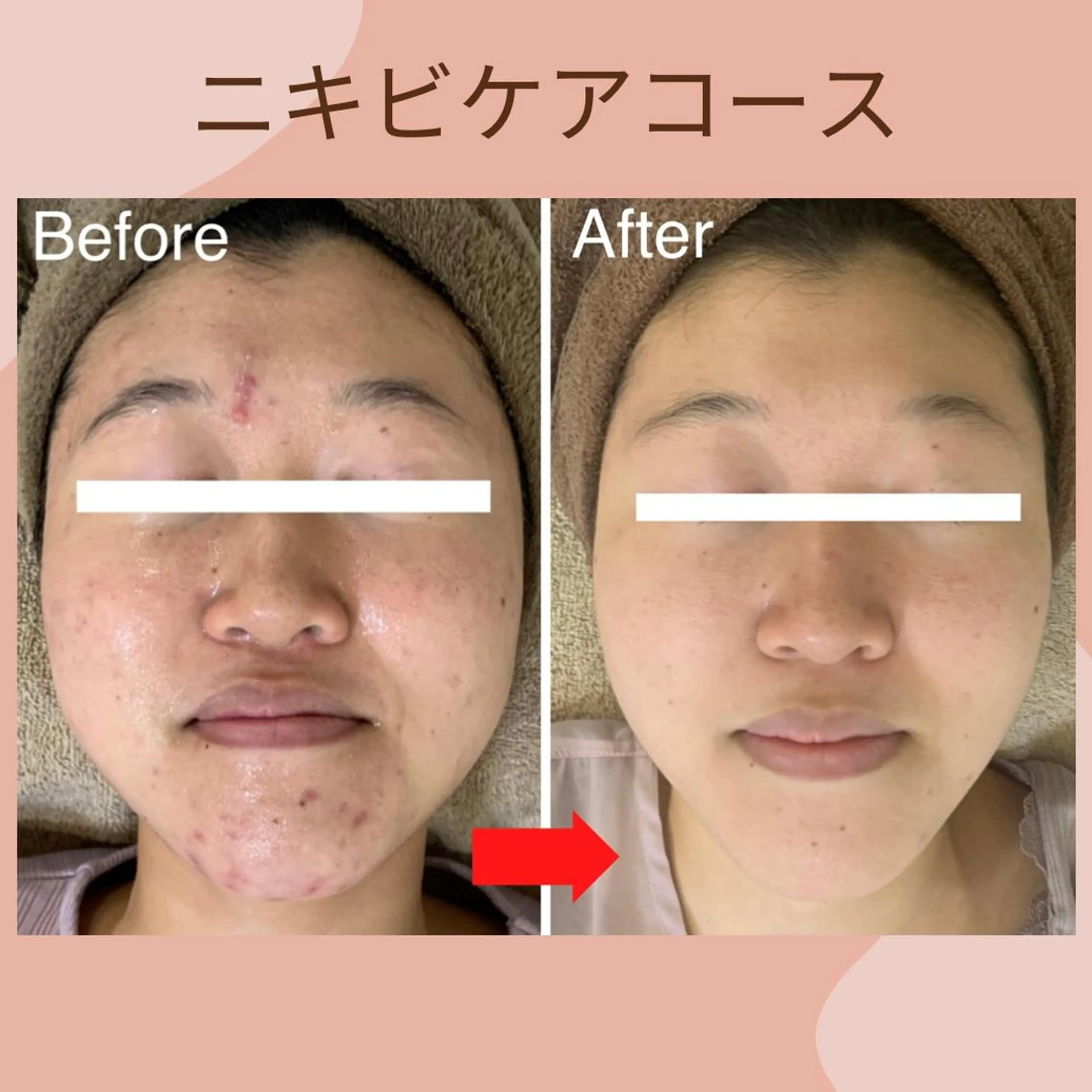 肌質改善✨お肌のお悩みに合わせて毛穴洗浄・パック・マッサージ（ニキビ・乾燥・皮脂過剰分泌のお肌におススメ）の写真