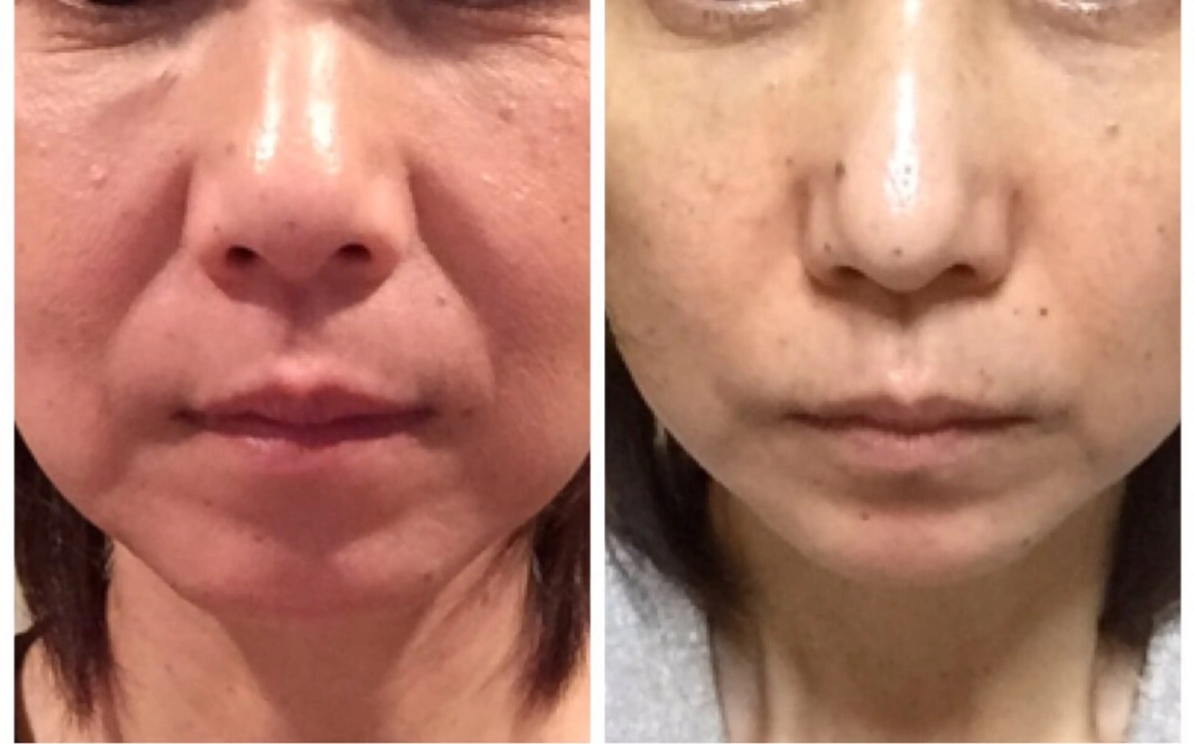 フェイシャルの写真