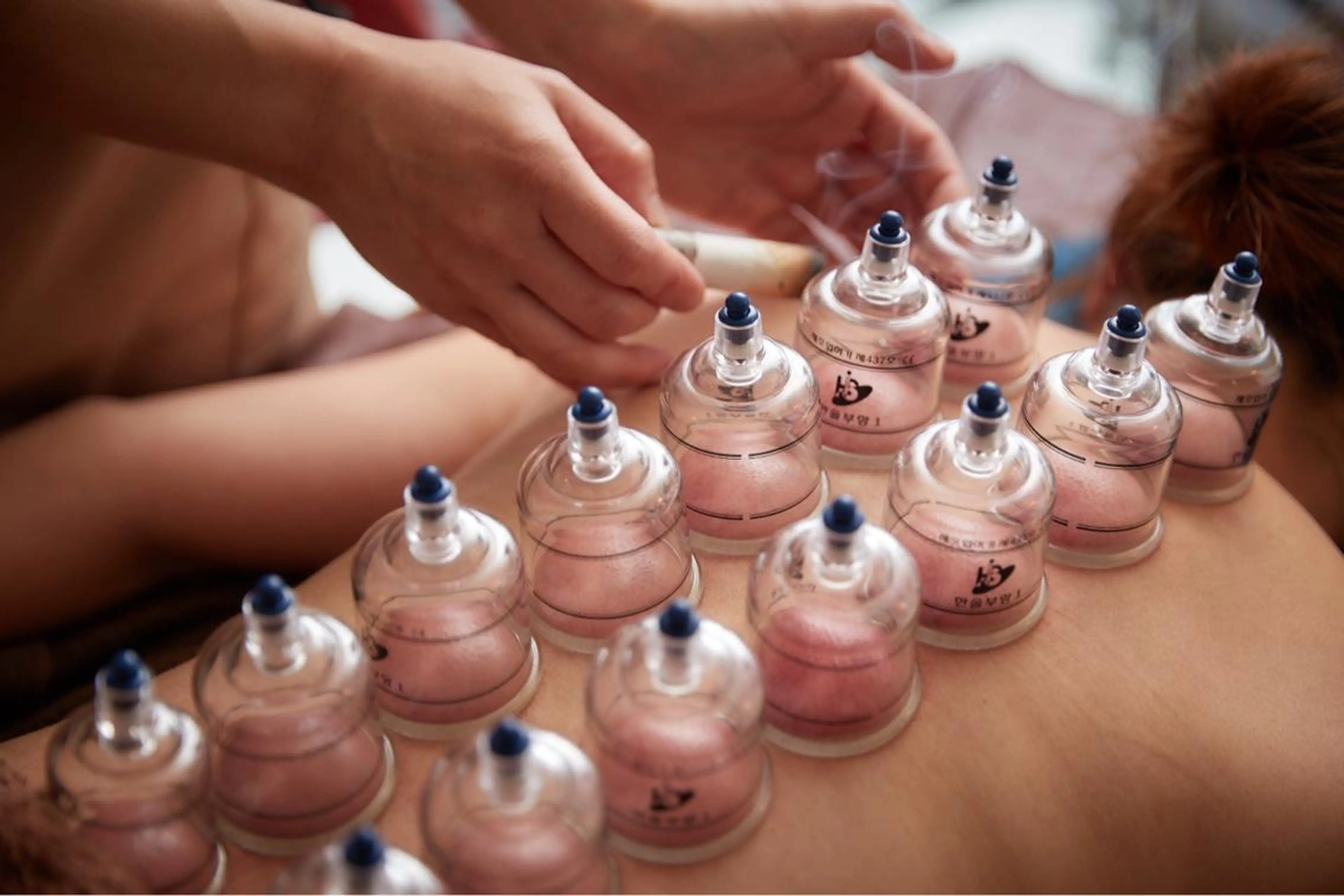 美楽鍼 びらくしんのその他イメージ