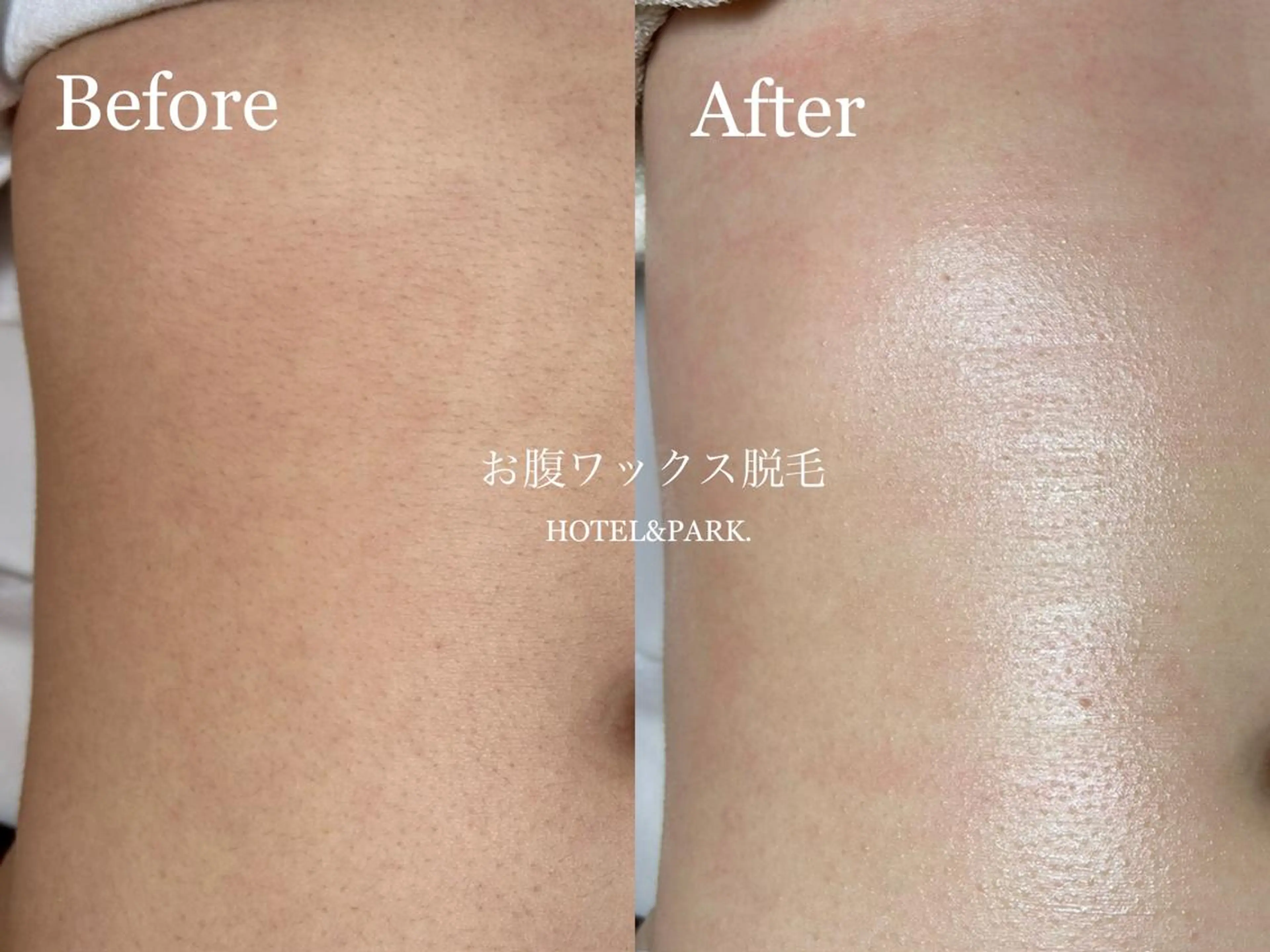 HOTEL&PARK . ワックス脱毛のエステ・リラクイメージ