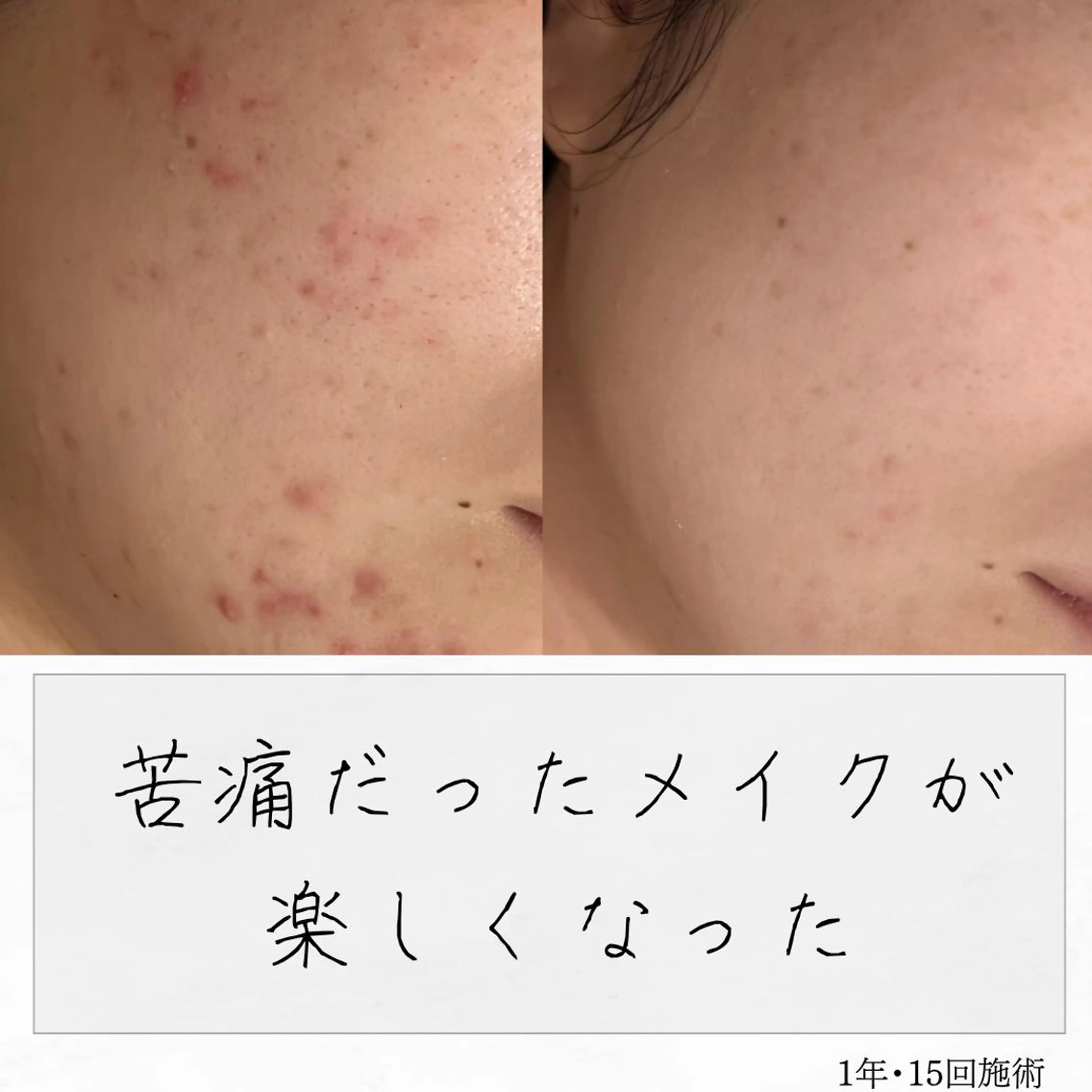 ニキビ経験者が施術 する専門サロン🌻のエステ・リラクイメージ