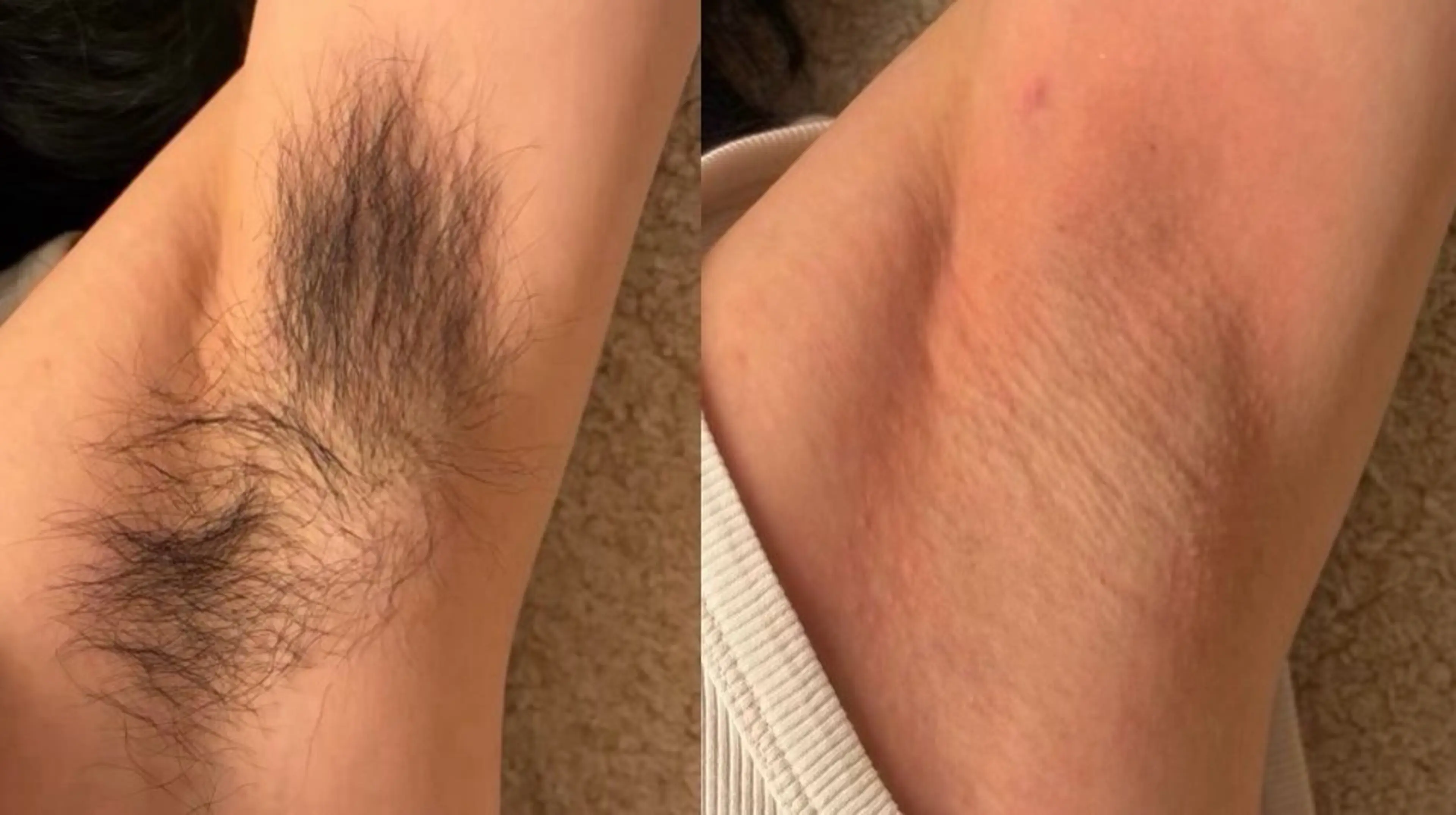 シュガーリング脇脱毛の写真