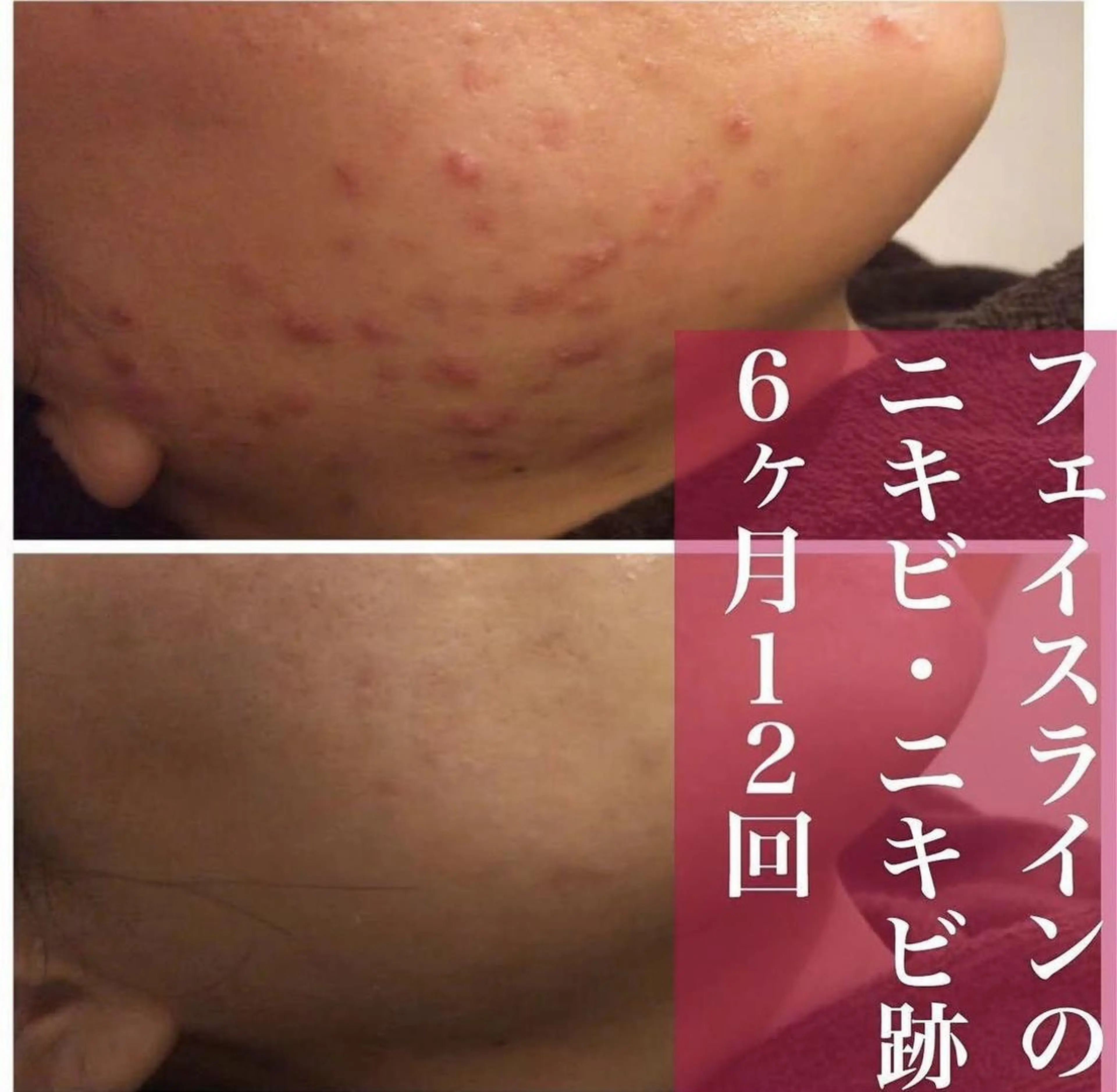 ショート メンズ キッズ マツエク・マツパ ネイル アイブロウ カラー パーマ ヘアアレンジ ニキビ跡改善専門🔥 医療にはできない改善のエステ・リラクイメージ