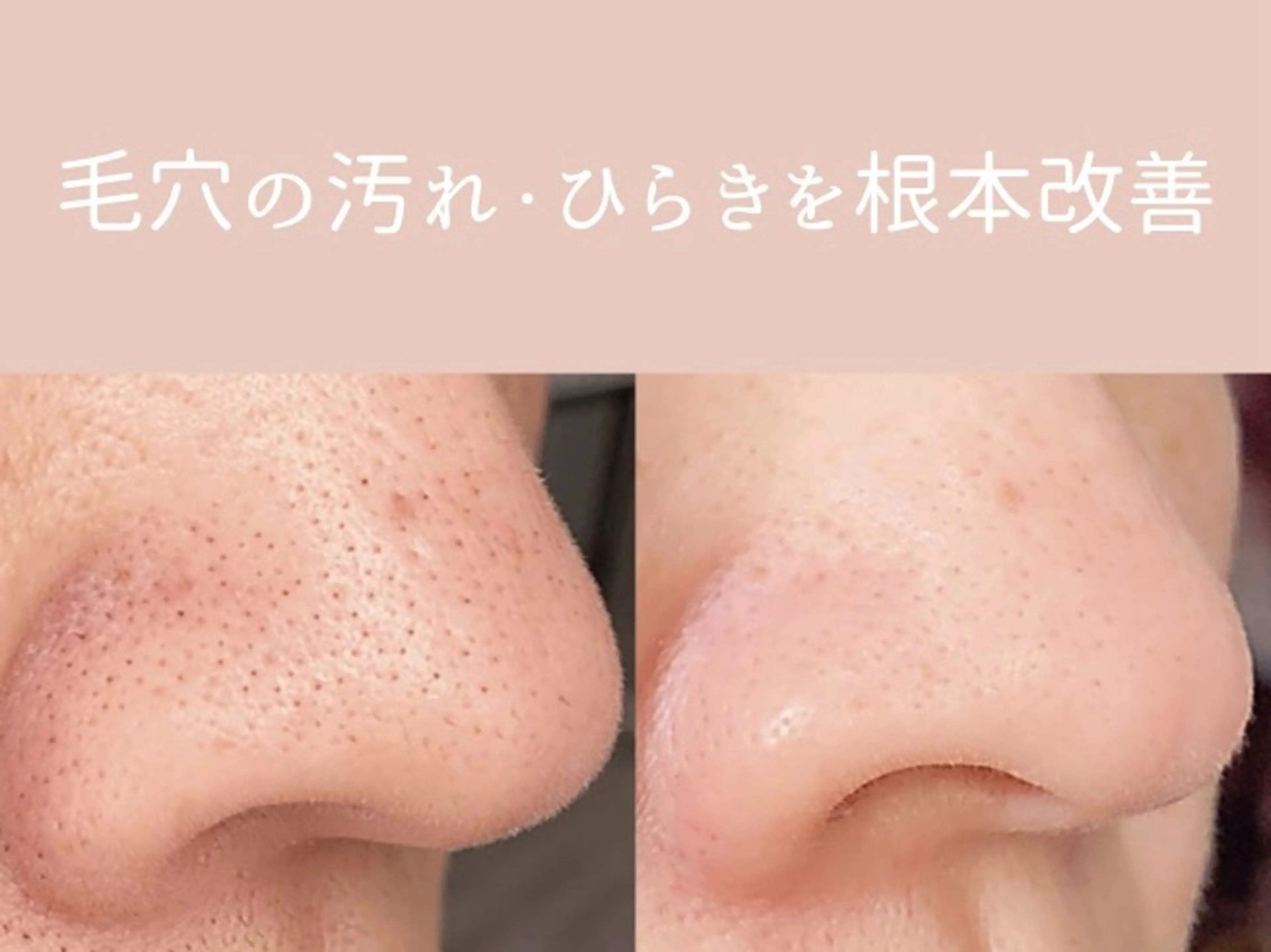 その他 小顔/毛穴/ニキビ salon bealのエステ・リラクイメージ