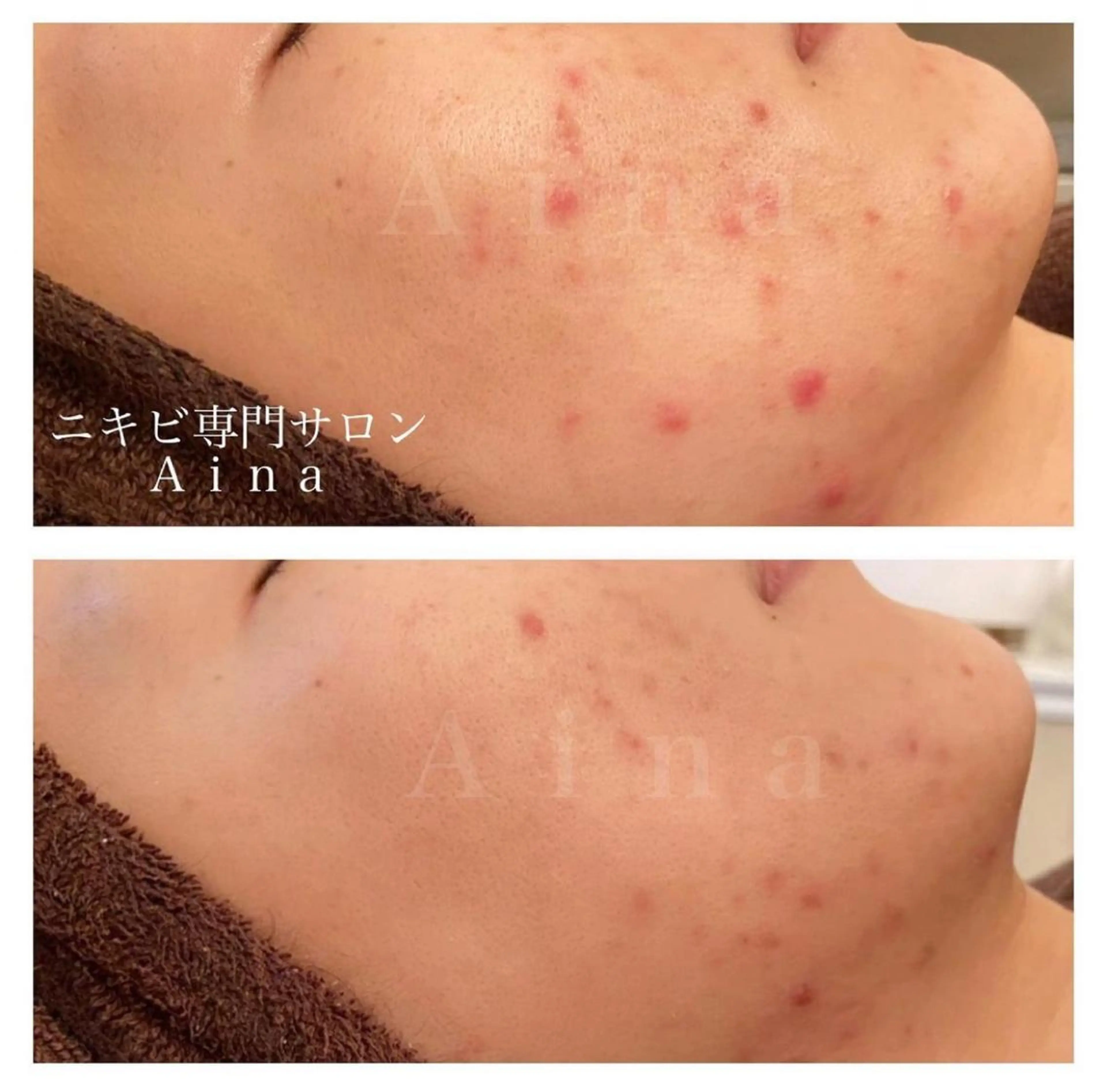 セミロング パーマ ヘアアレンジ メンズ キッズ ネイル マツエク・マツパ アイブロウ エステ リラク ニキビ跡専門サロン Ａｉｎａのエステ・リラクイメージ