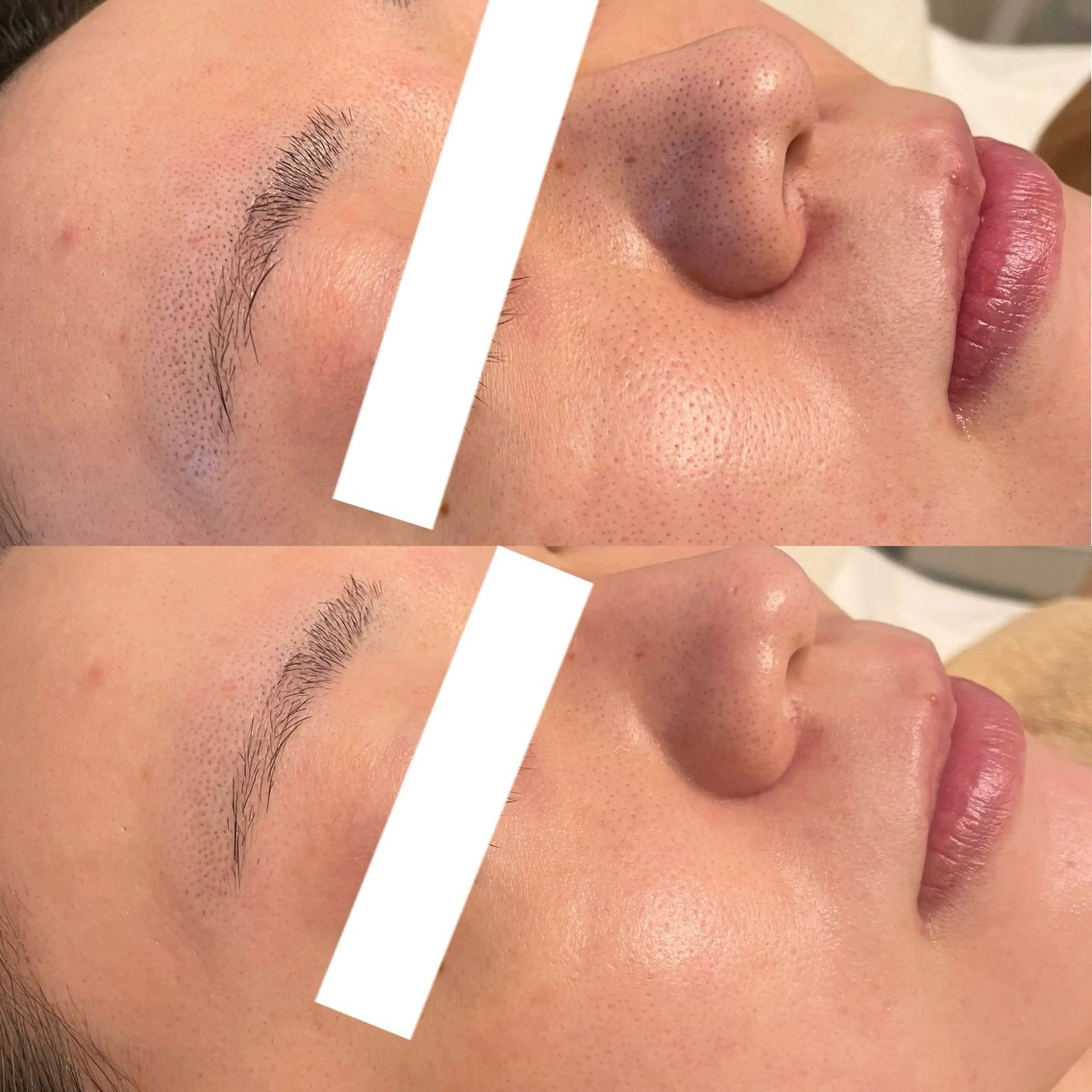 ハイドラピーリングの写真