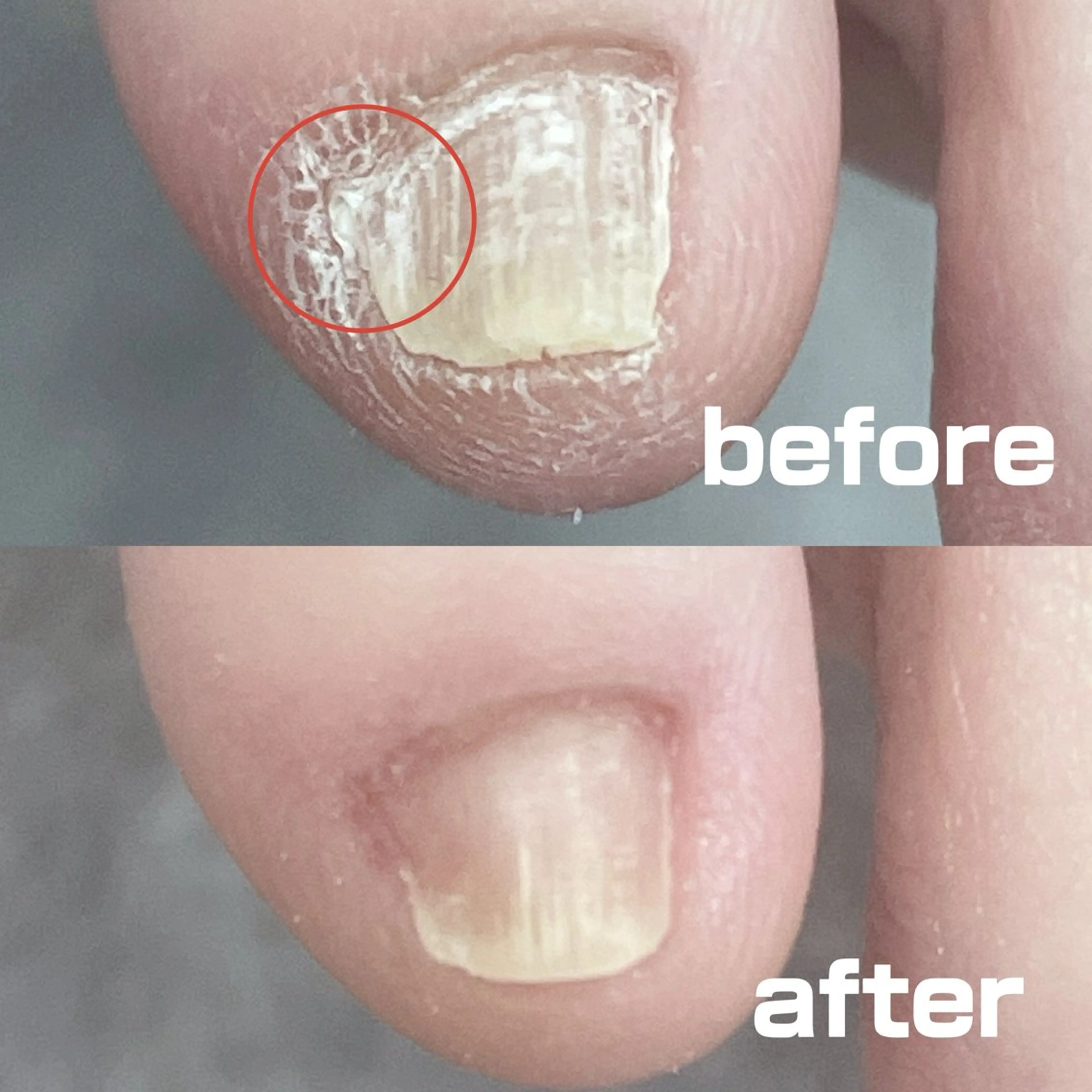 副爪（ふくそう）ケア　1趾の写真