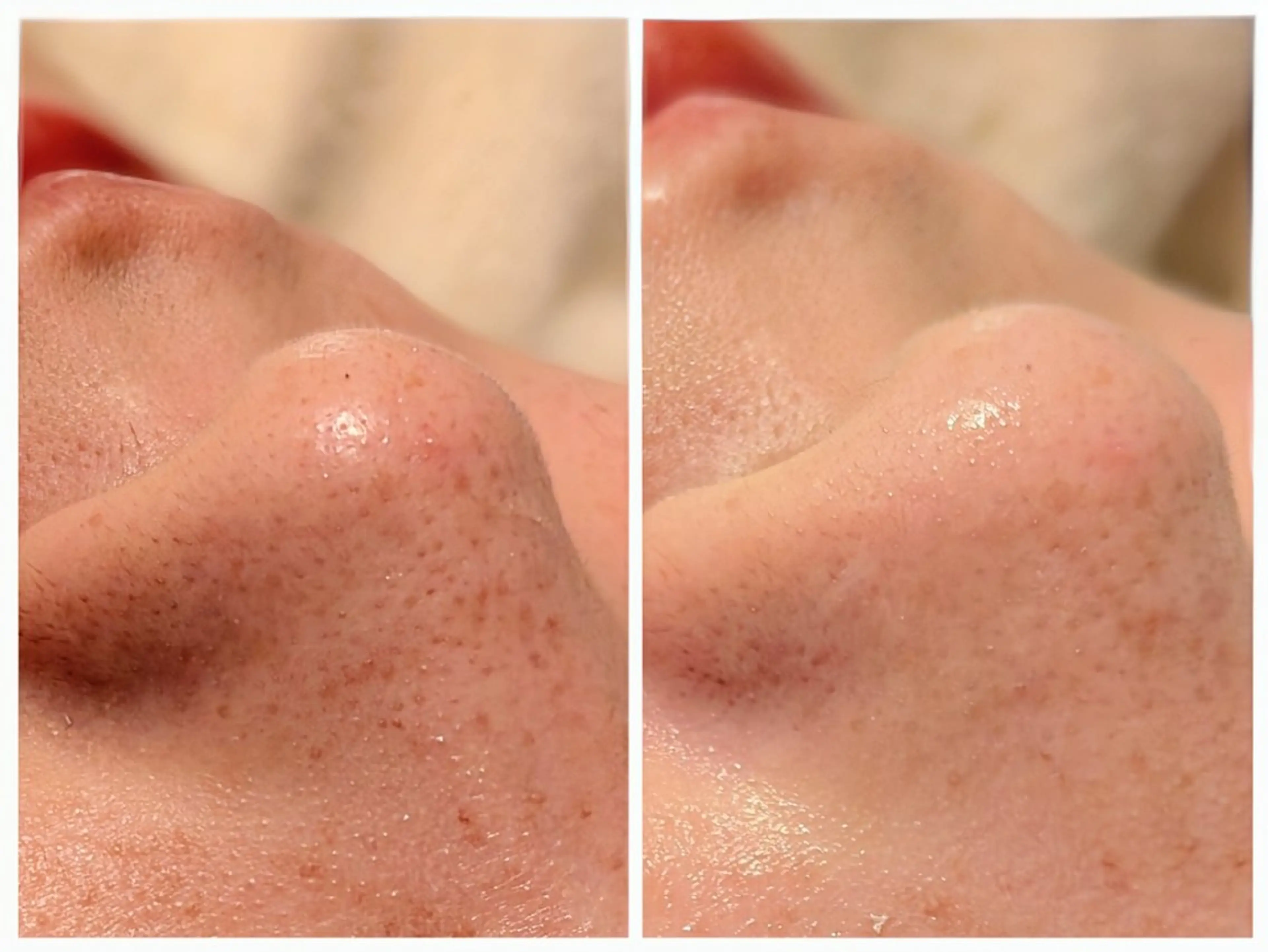 “鼻周辺のみ毛穴エクストラクションコース(ヘッド付き)90分11000円の写真