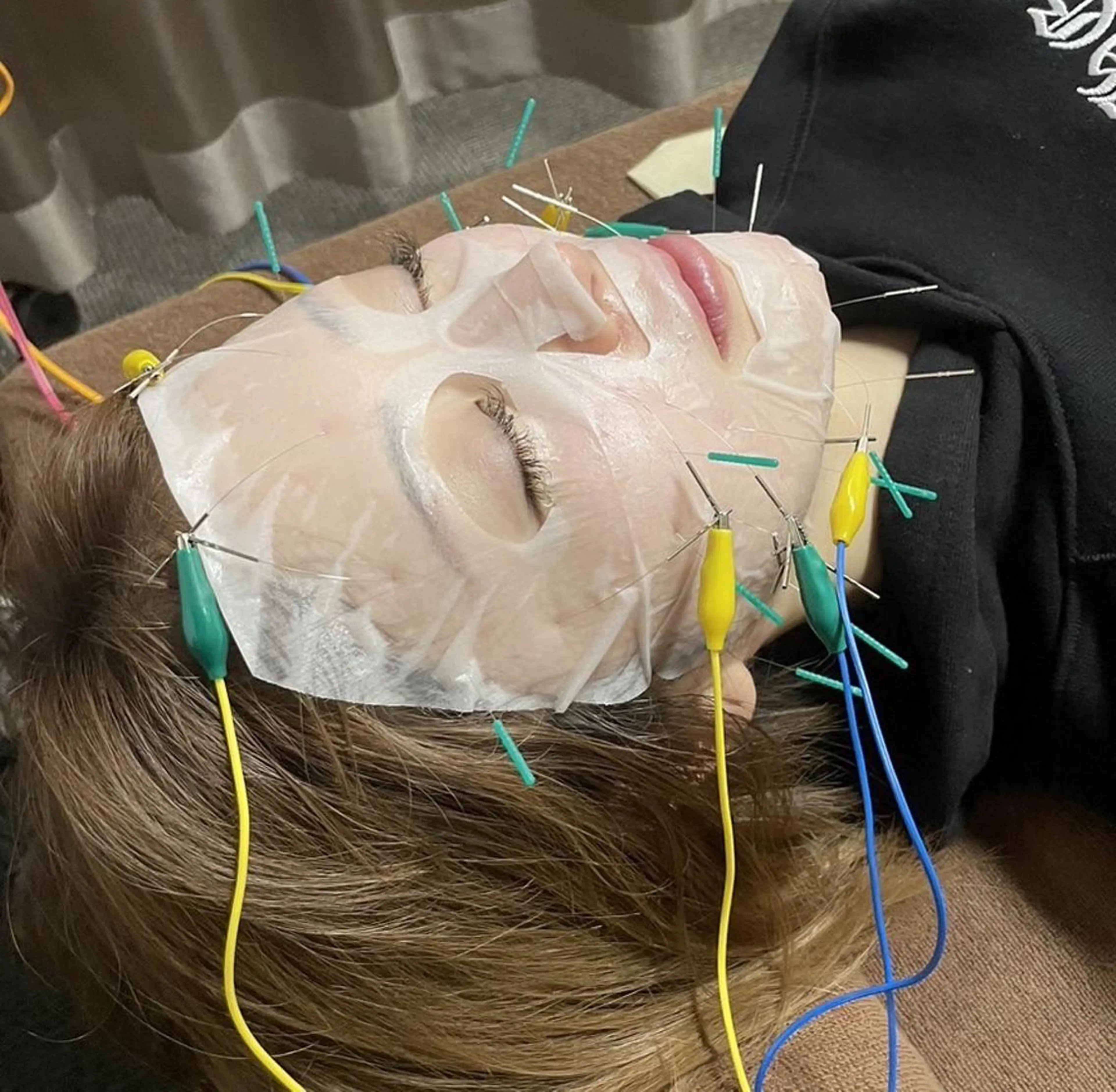 プラセンタ電気美容鍼の写真