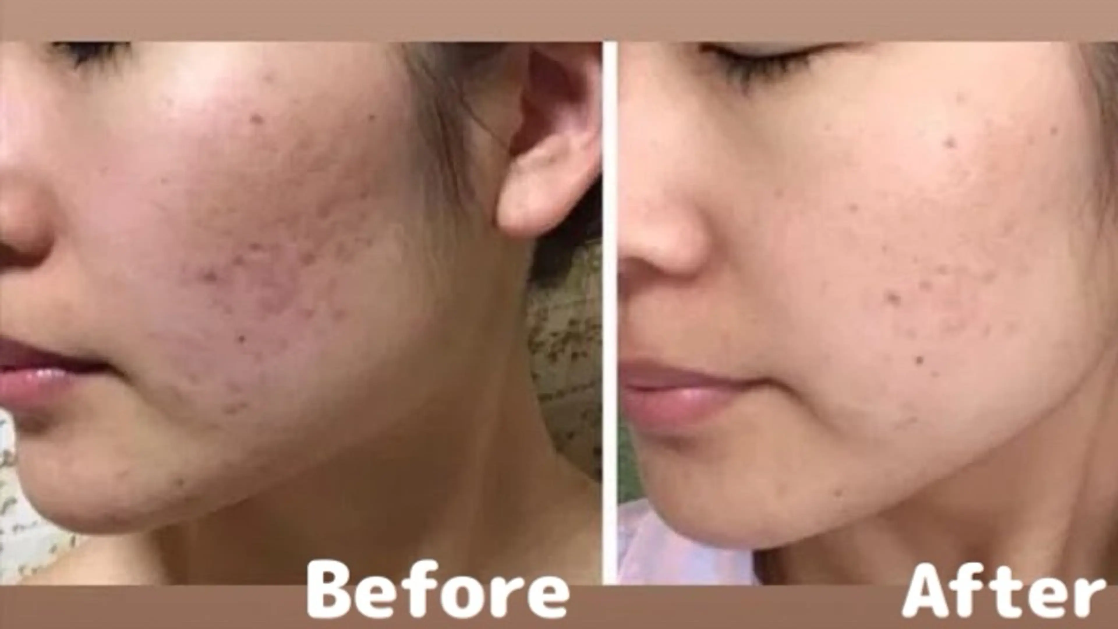 エステ リラク ANABEL+所属・肌の質を変えるエステ 🤍🫧Nanaのエステ・リラクイメージ