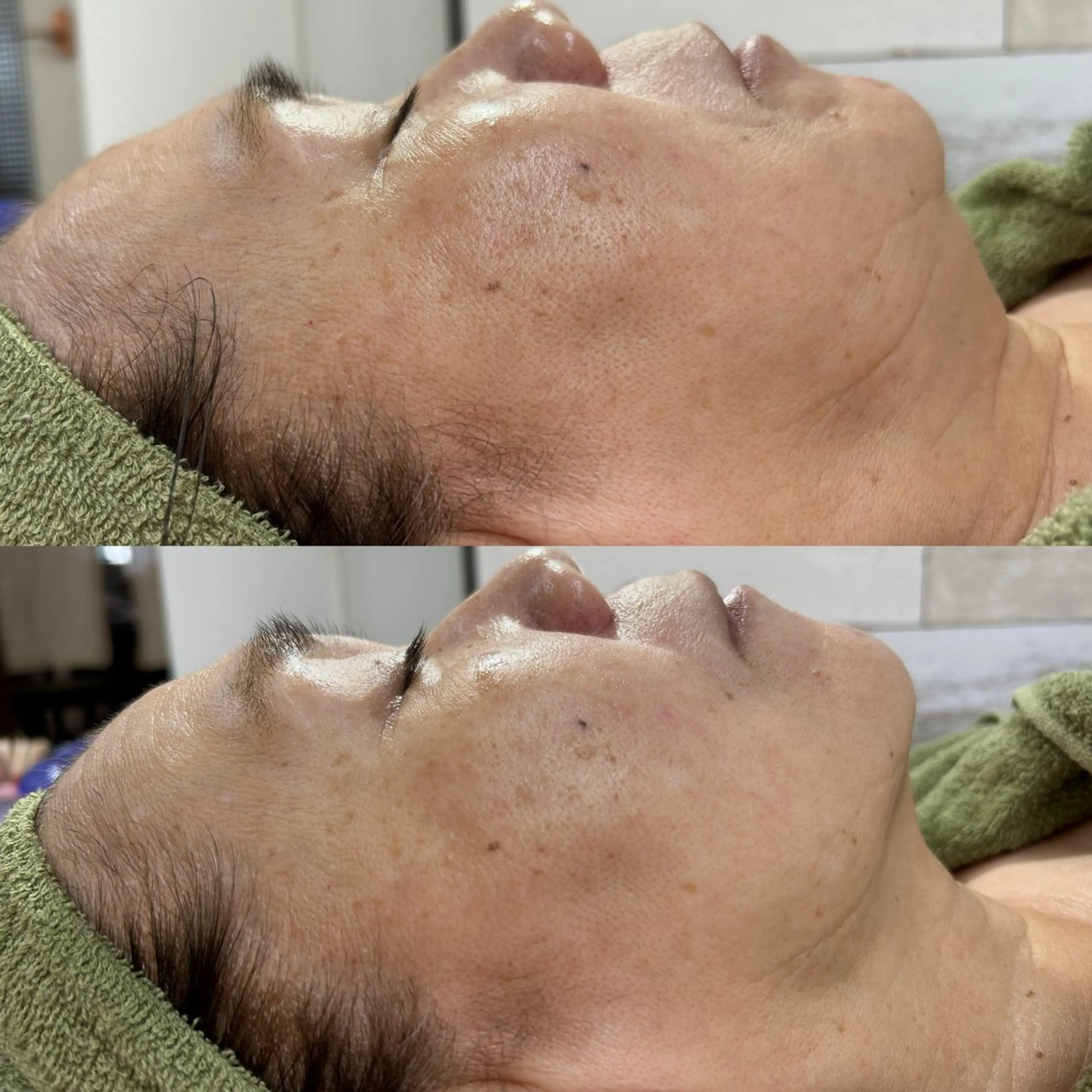 -15歳の肌を！たるみやしわ、ハリのない肌からさよなら！プラズマフェイシャル(顔・首)の写真