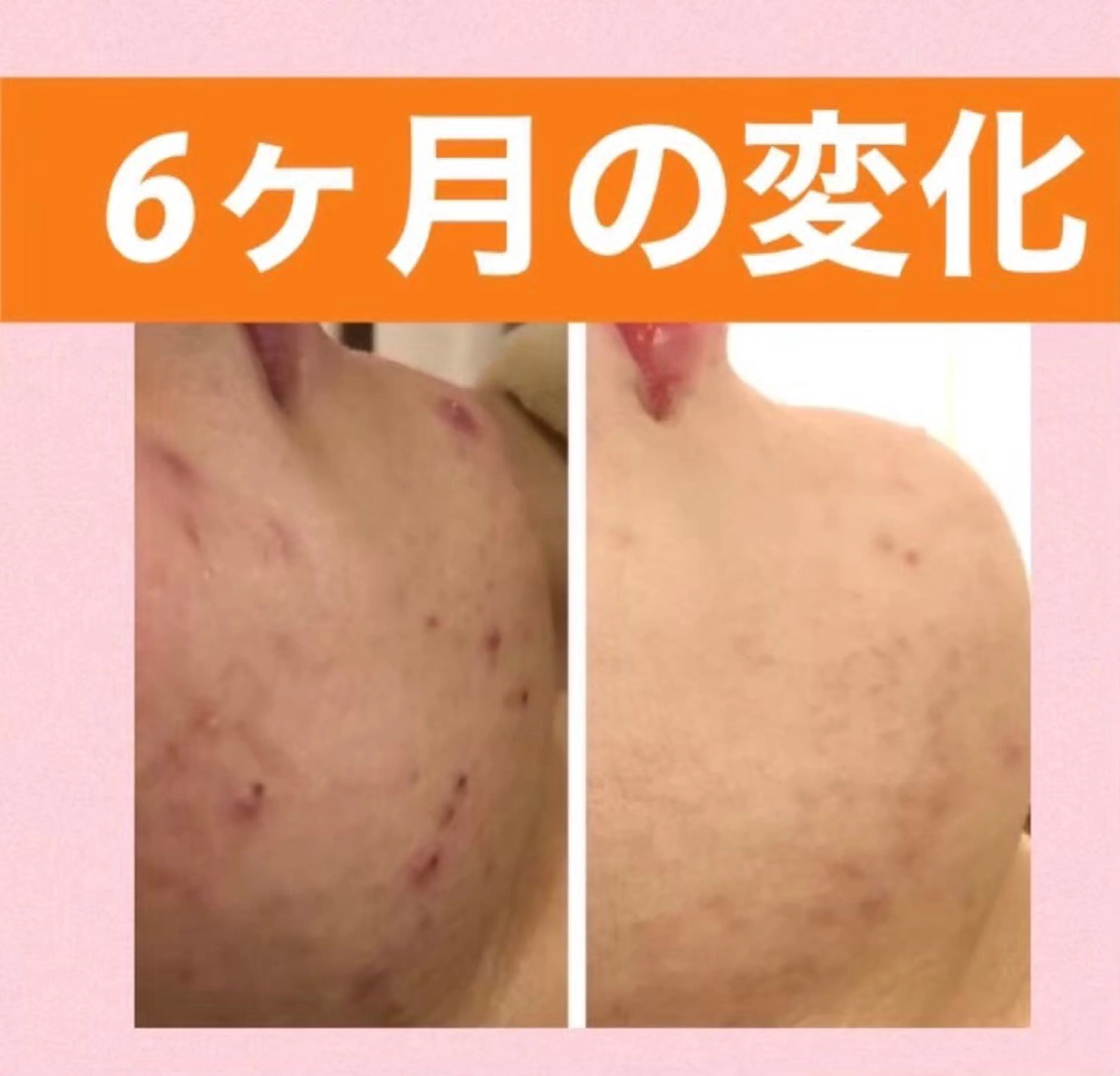 メンズ キッズ ニキビ専門 肌トラブル解消サロンのエステ・リラクイメージ