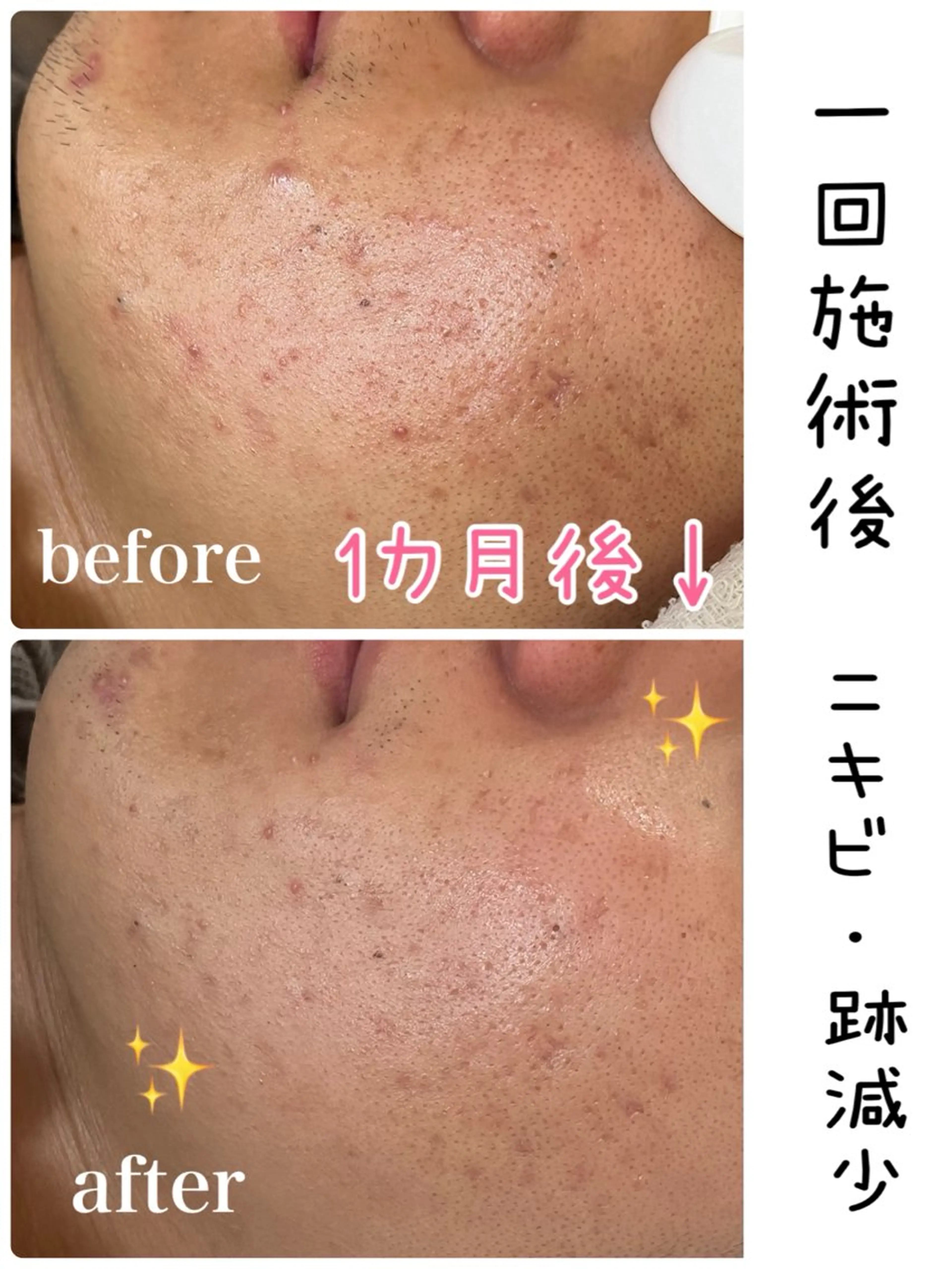 ザラツキ、ニキビ跡にはコレ🥰→毛穴洗浄【ダイヤモンドピーリング】毛穴吸引&ダーマブレーションでお肌を磨きつるんと肌への写真