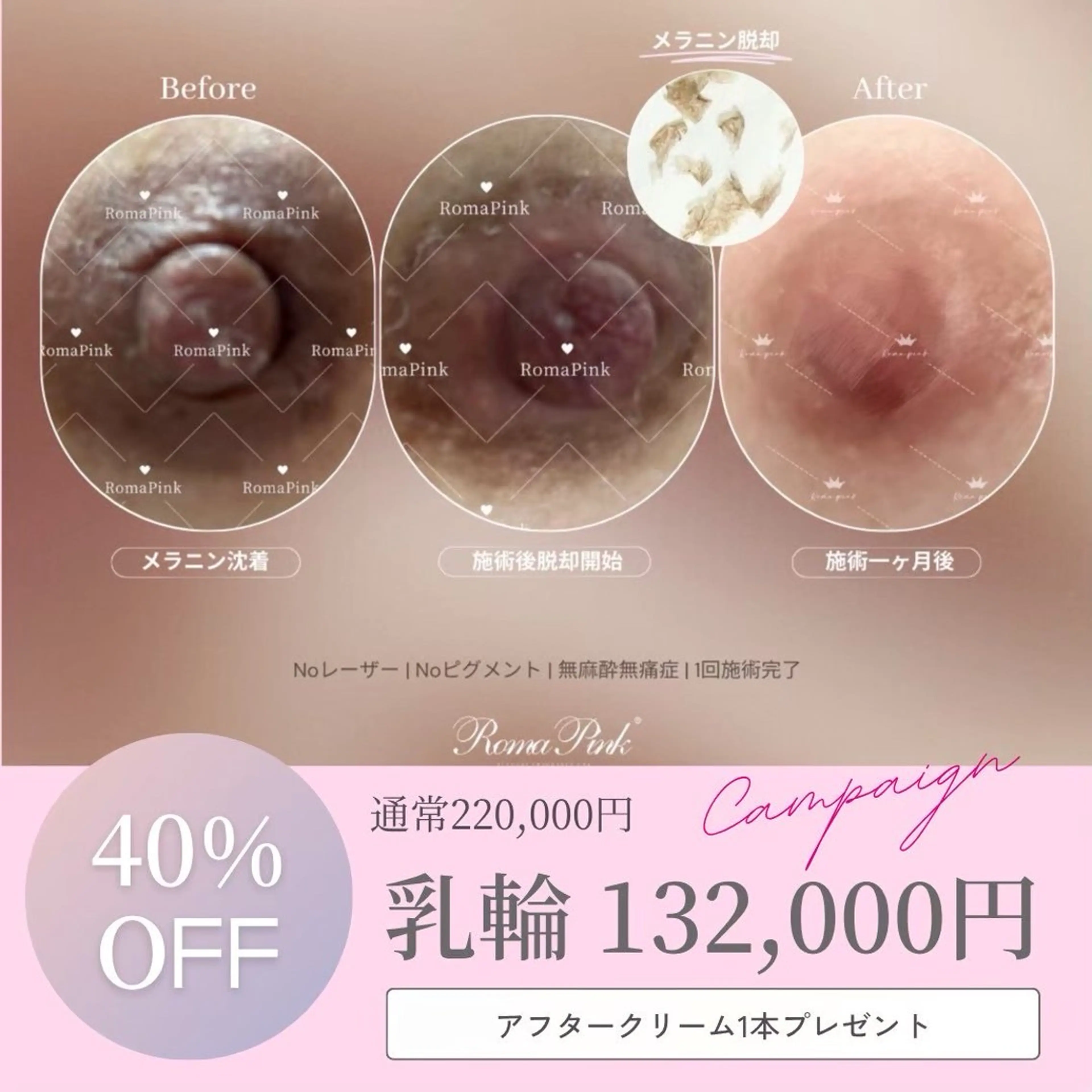 導入キャンペーン❗️乳輪・乳頭《40%OFF》¥222,000→132,000🌟アフターケアクリーム付きの写真