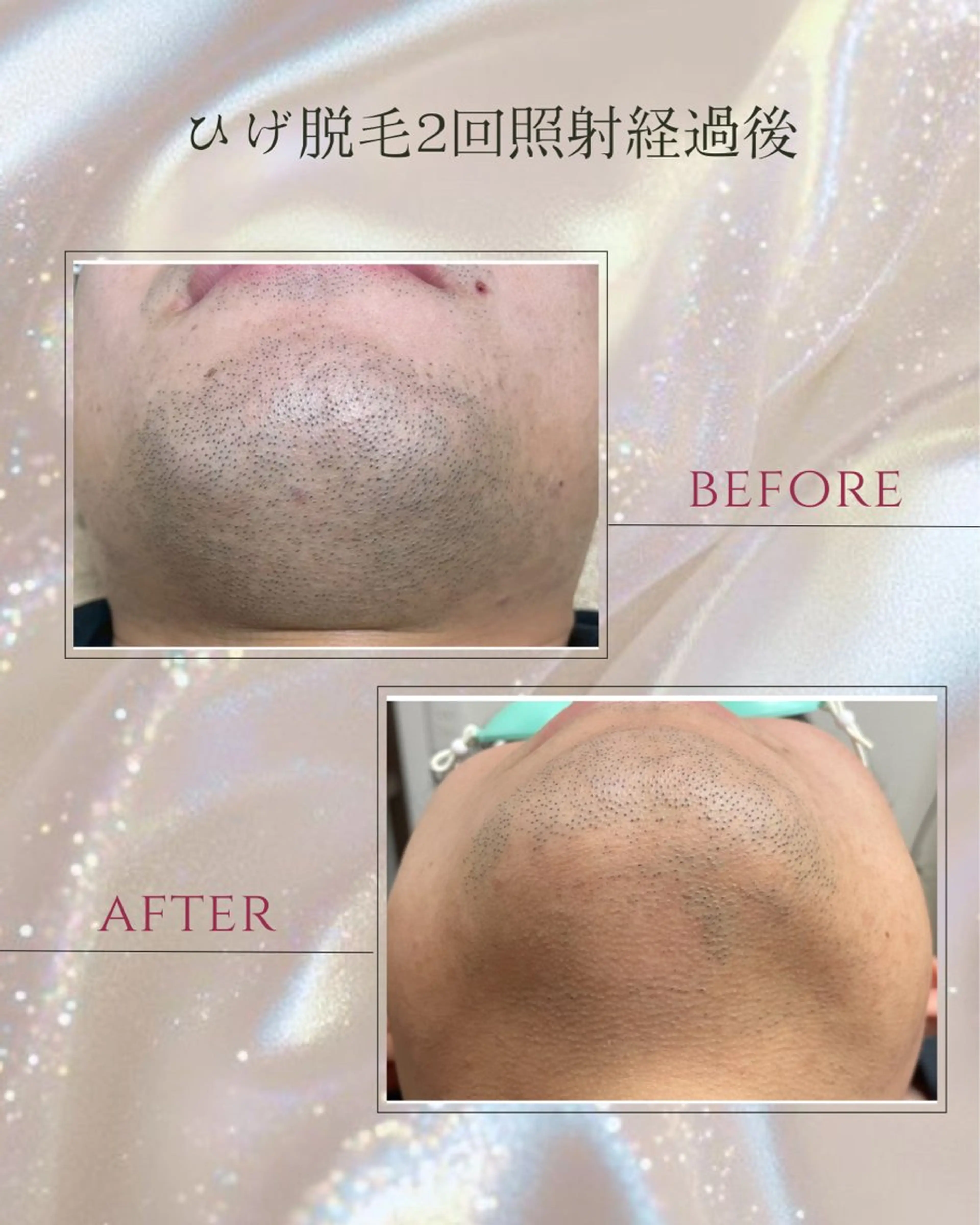 脱毛 DISINI  SPA所属・DISINISPA 脱毛/フェイシャルのエステ・リラクイメージ