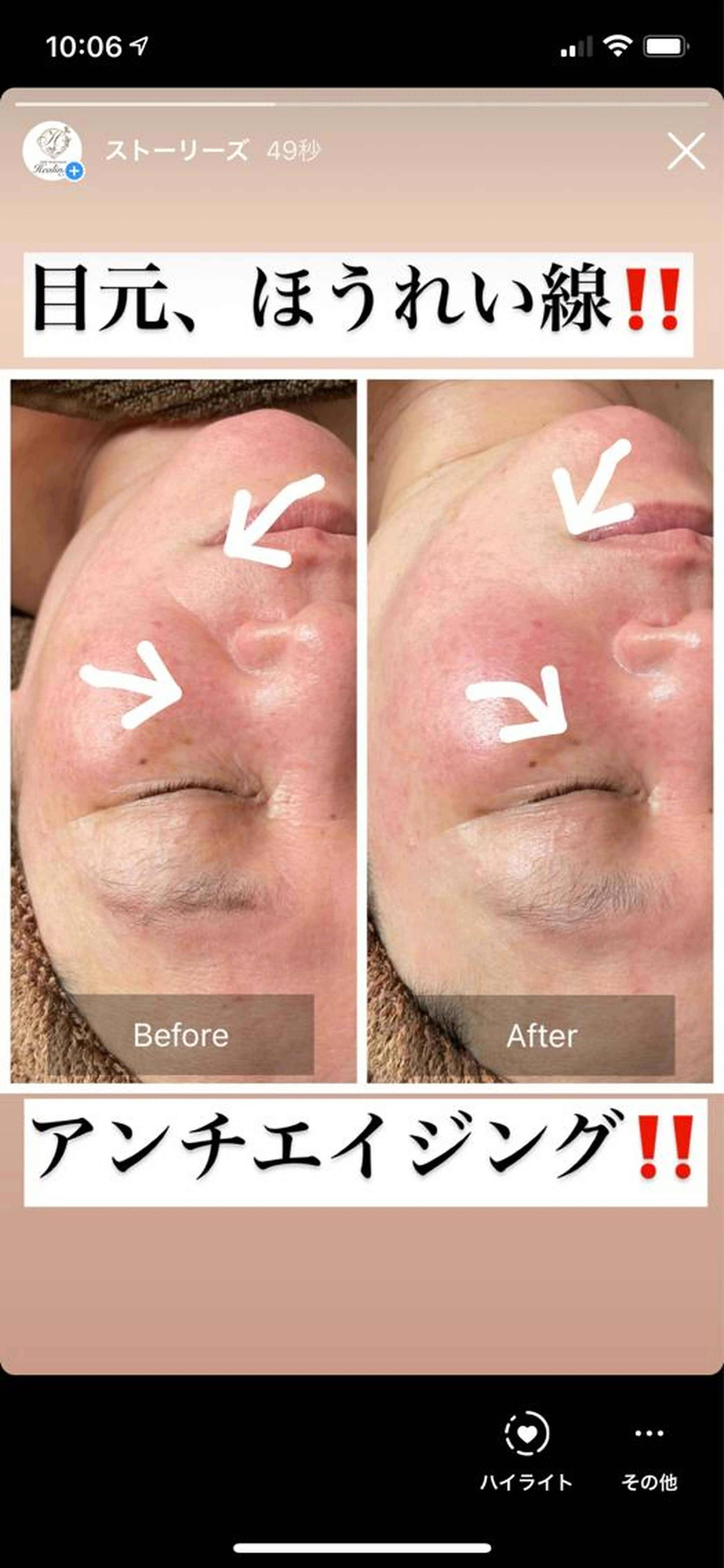 今！！話題の小顔フェイシャル‼️フェイスライン、二重アゴ、ほうれい線に！の写真