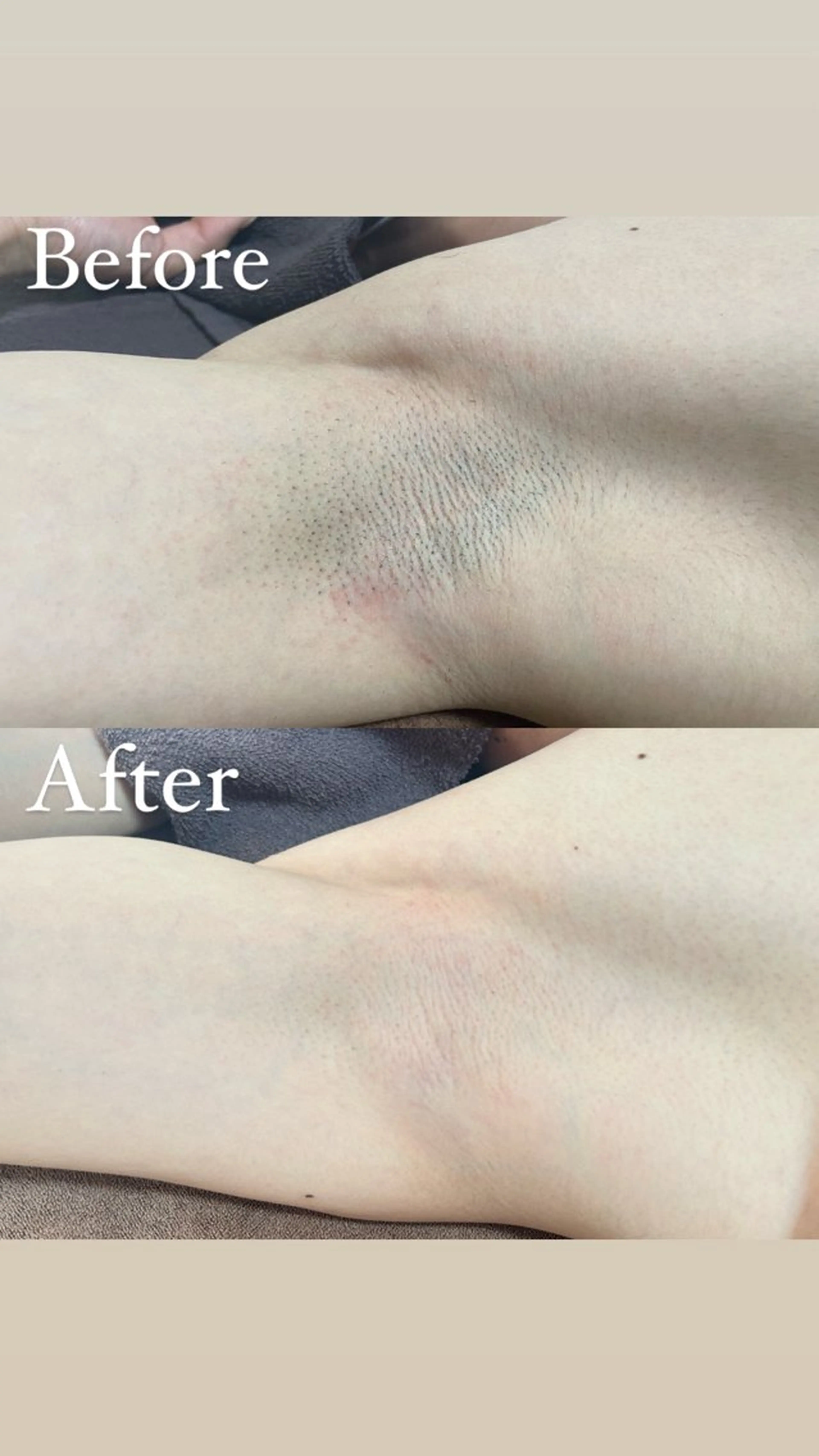 4/30まで🌸⚠️先着5名限定⚠️【ワキ、うなじ、ヒゲ、ひざ上、ひざ下、ひじ上、ひじ下】からお好きな2箇所✨の写真