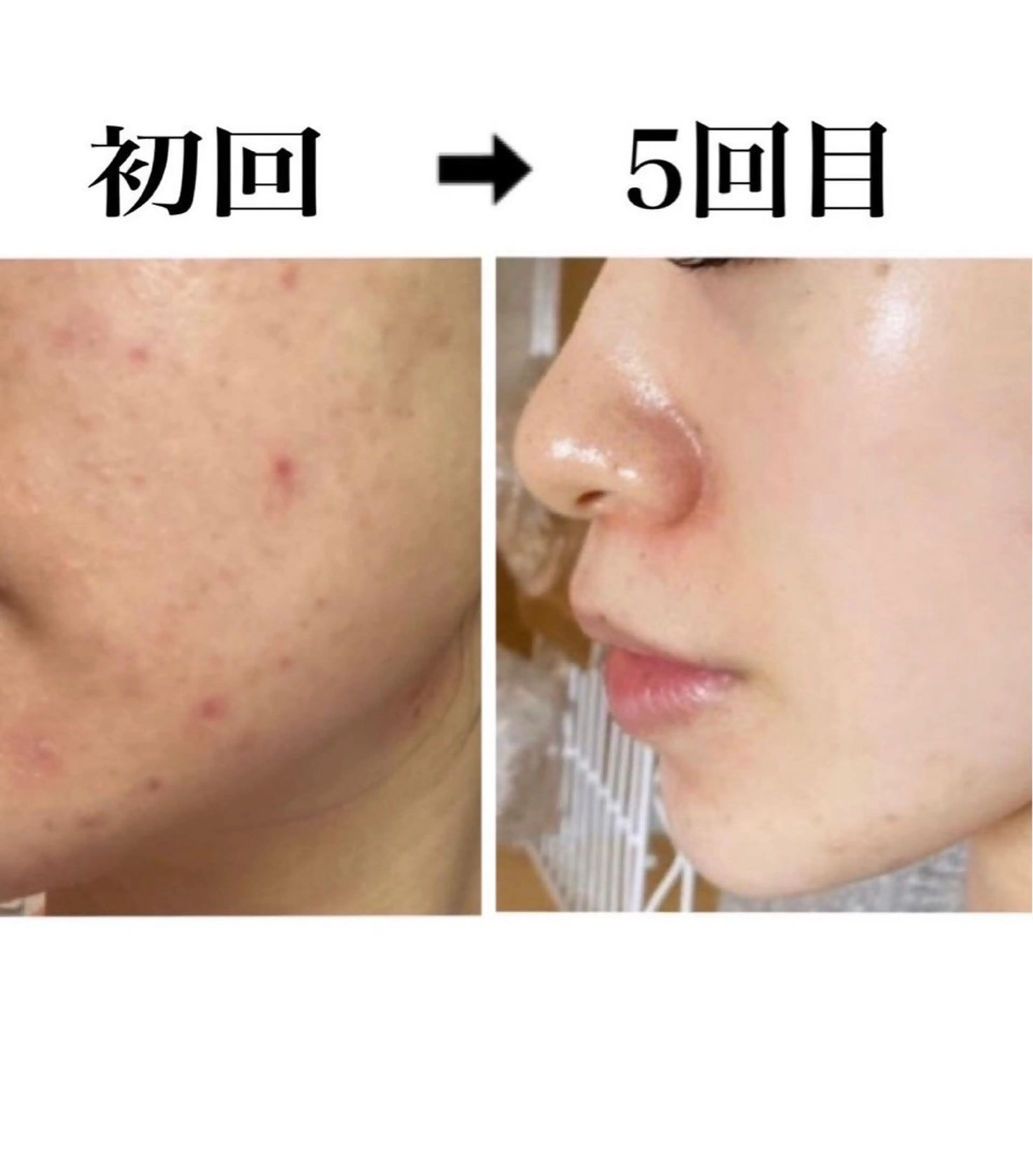 エステ skin make salon -Olu's-所属・毛穴・肌質改善サロン ✨Tomaのその他イメージ