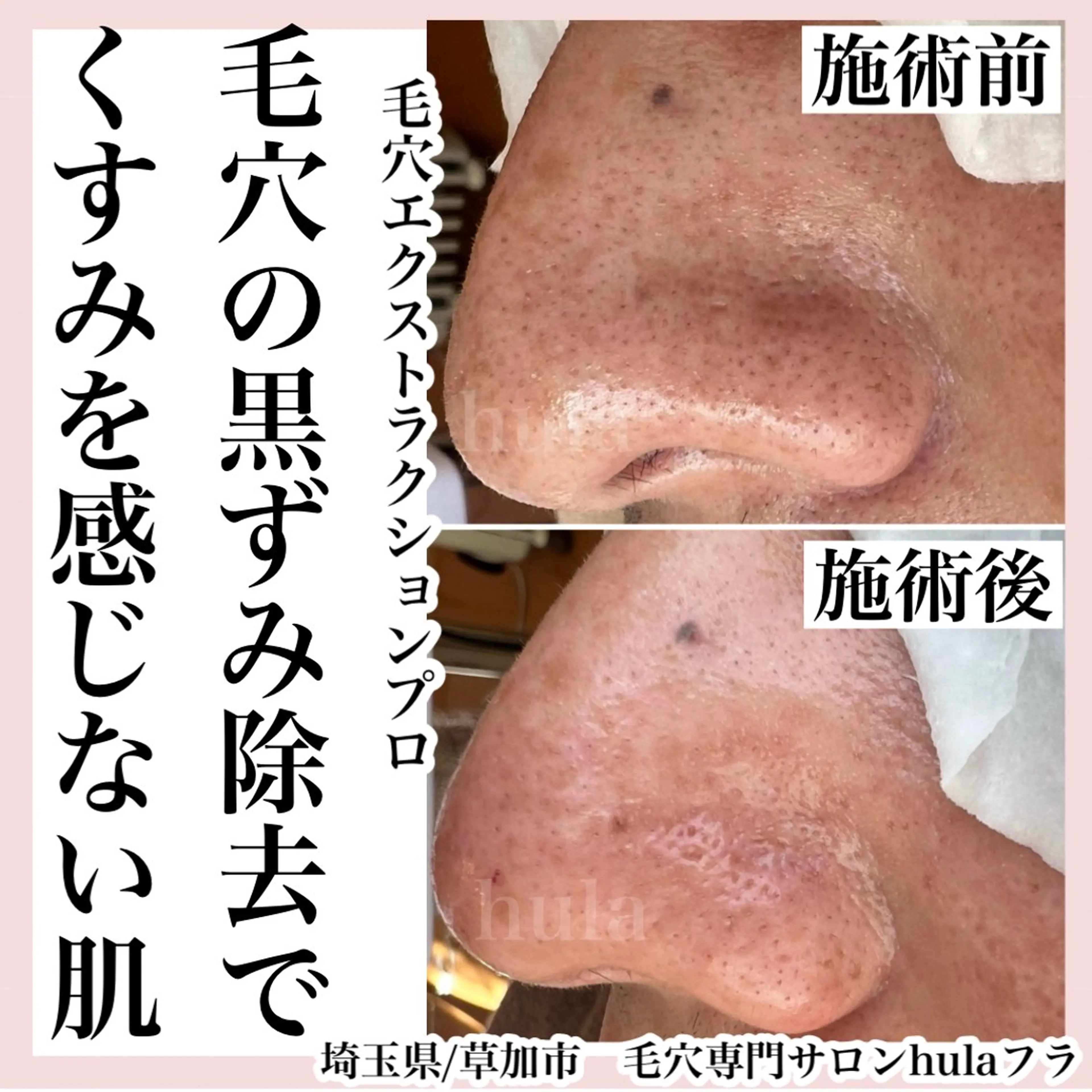 毛穴専門店hula 杉山智美のエステ・リラクイメージ