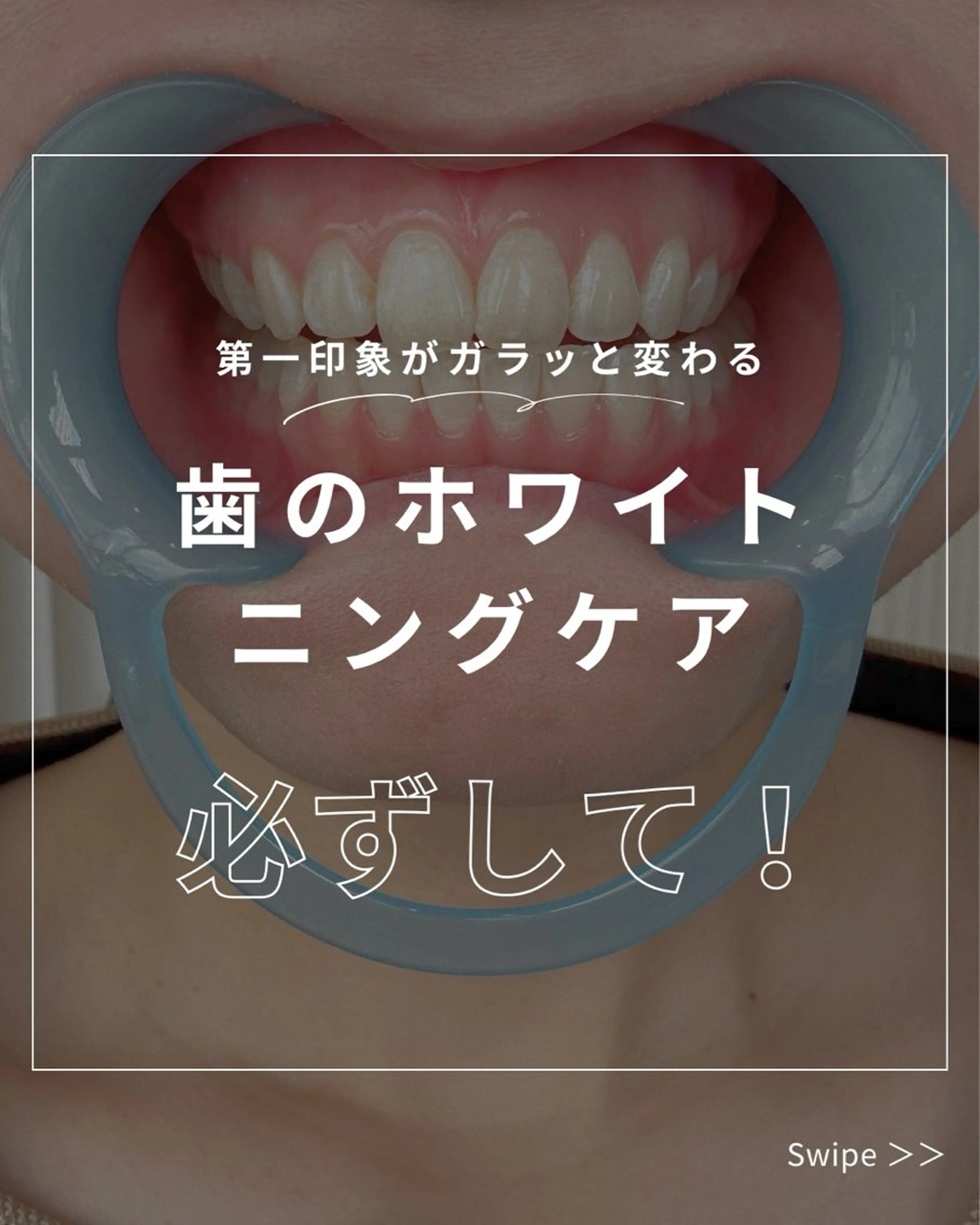 【美歯口】ホワイトニング🦷✨の写真