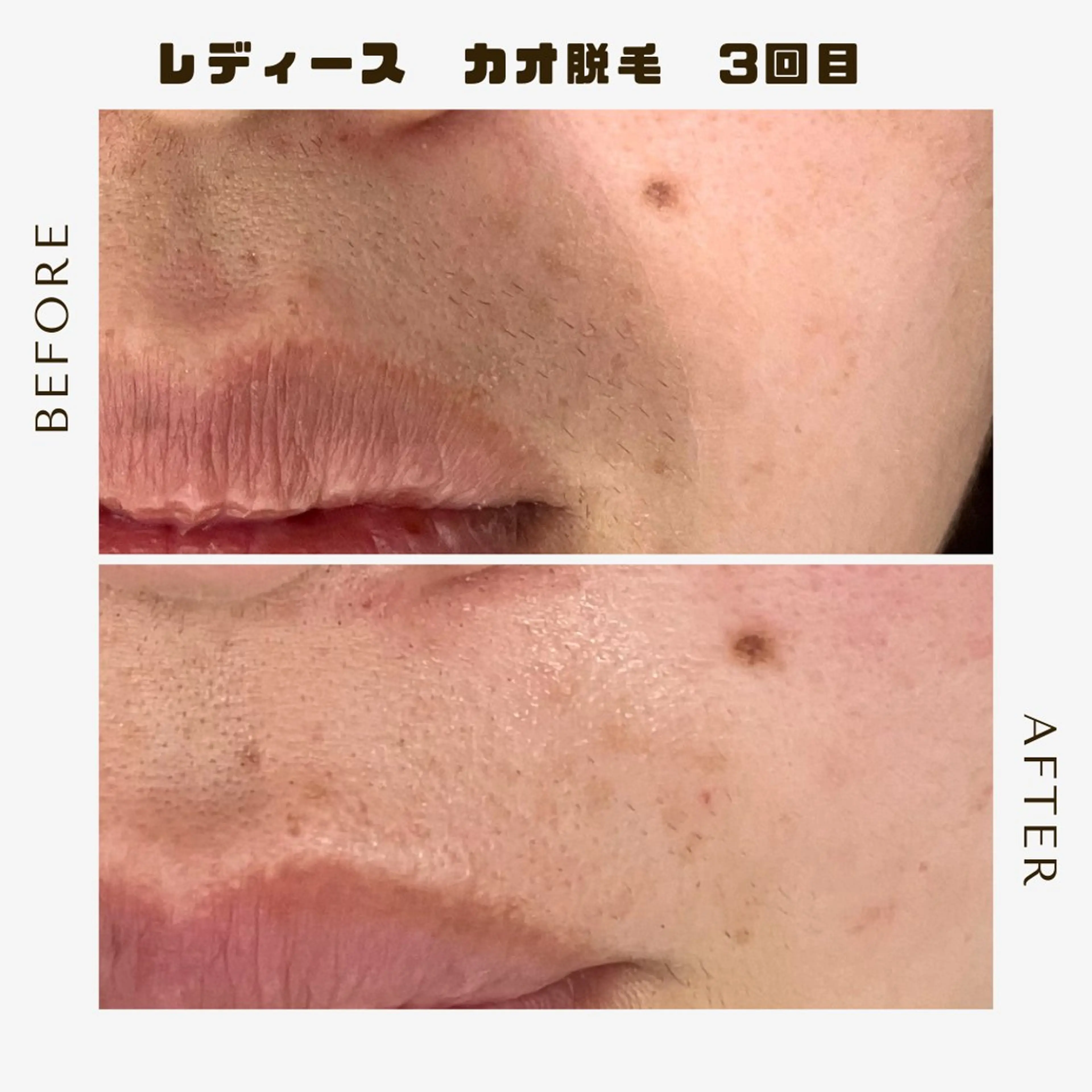 脱毛 脱毛＆フェイシャル/ Rappore;増田のエステ・リラクイメージ