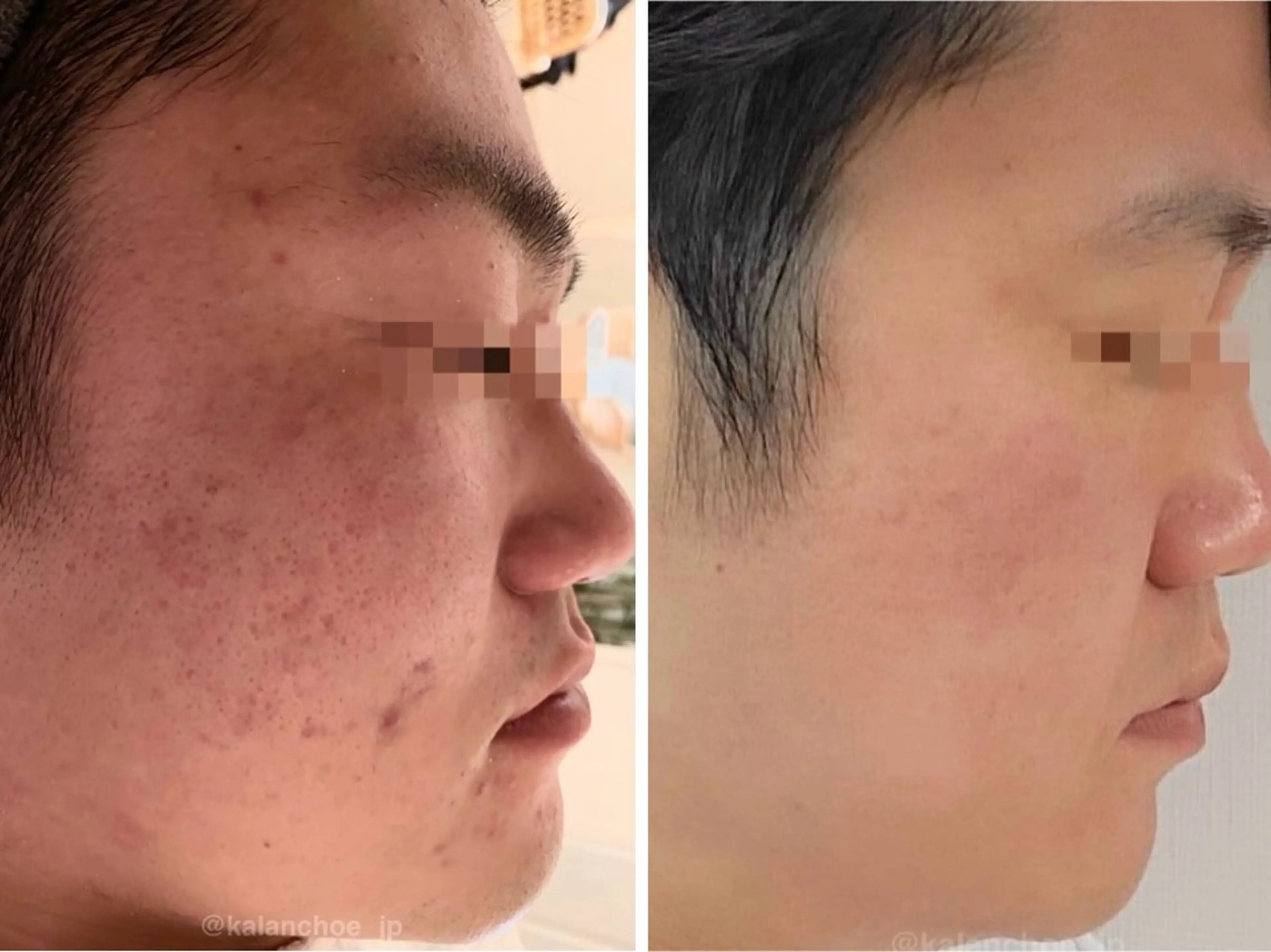 エステ 肌質改善 KALANCHOEのエステ・リラクイメージ