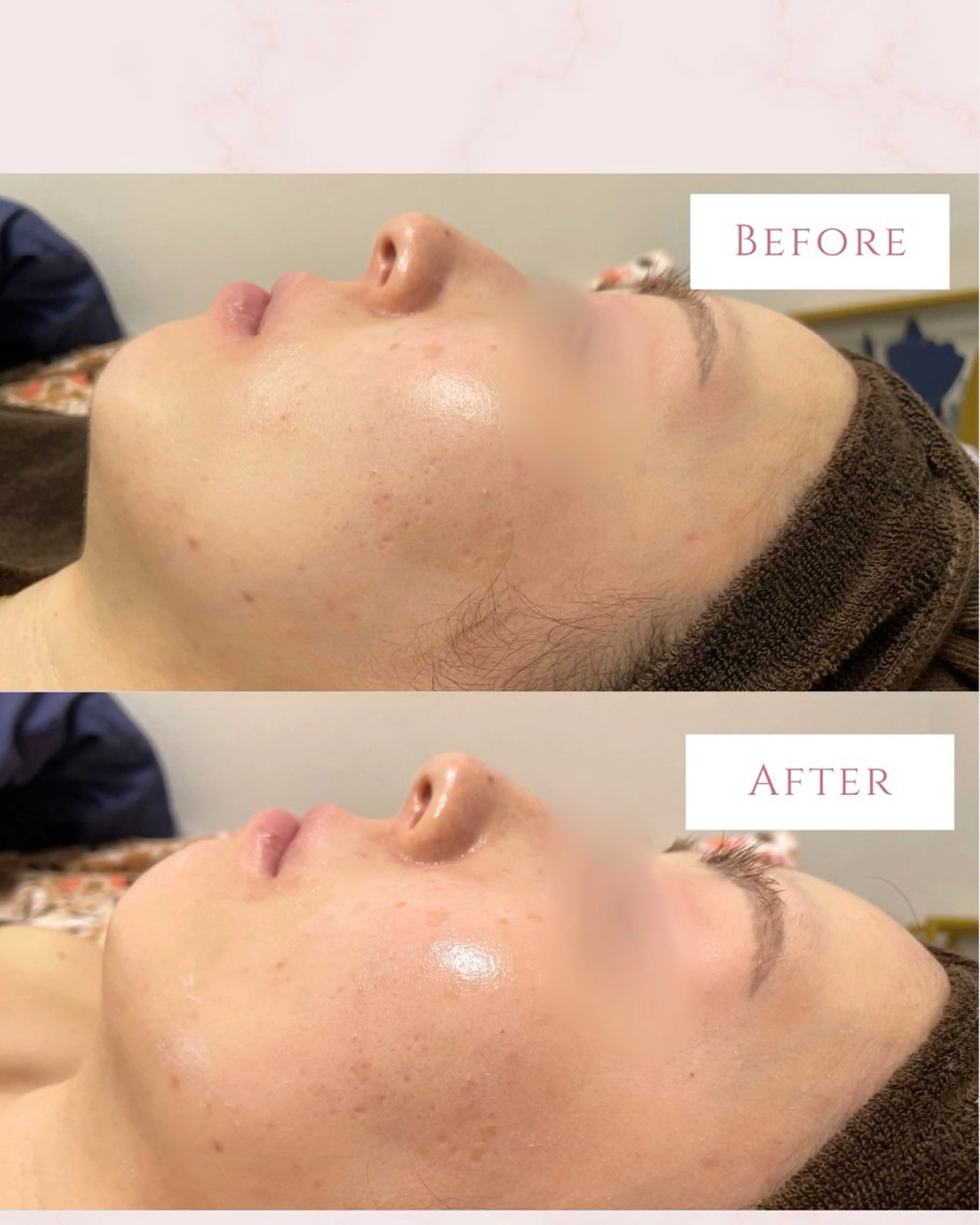 エステ pure所属・肌質改善ピーリング pure 一番町のエステ・リラクイメージ