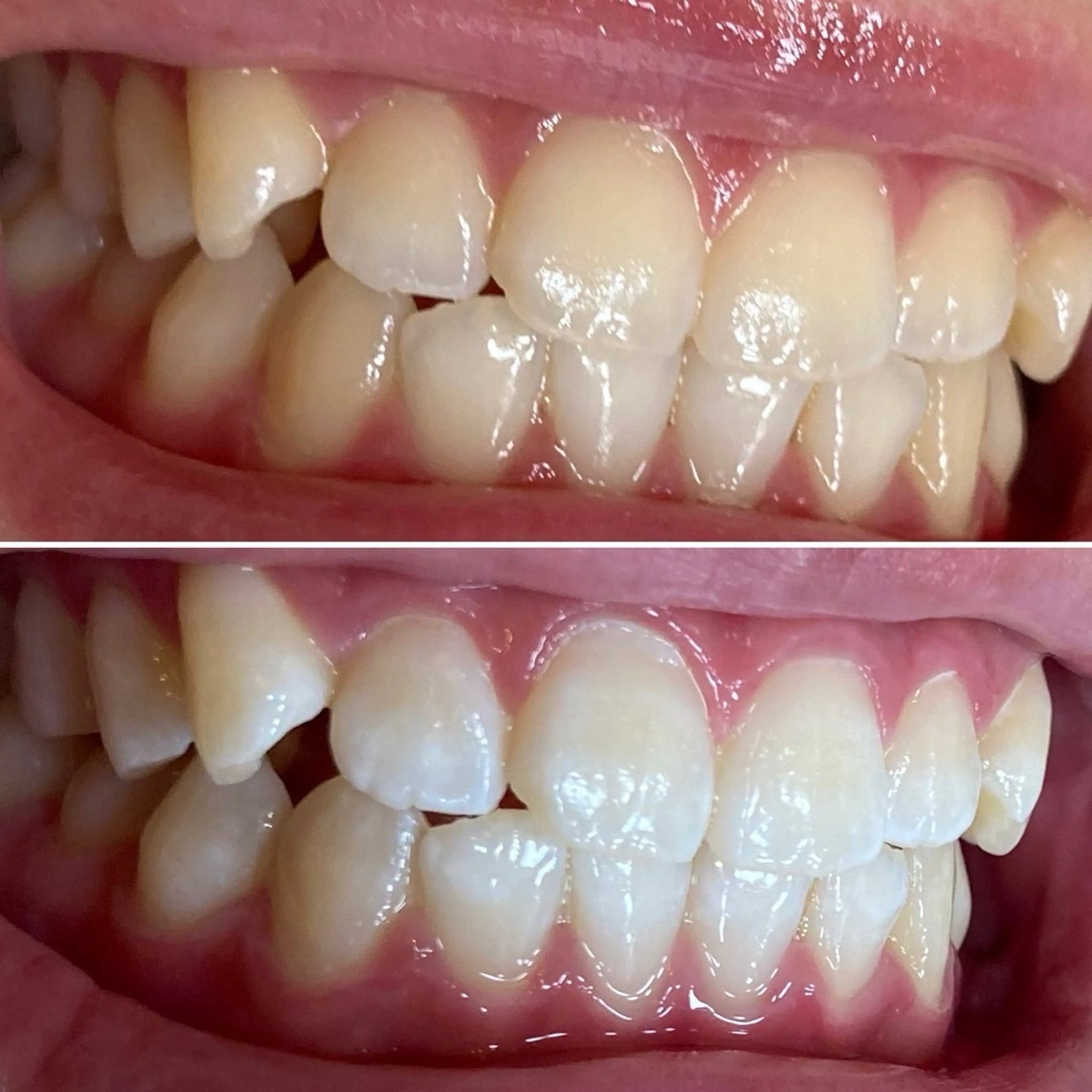 歯を自然な白さに！🦷✨【照射時間15分×2回の30分】メンズも大歓迎♪口コミ協力してくれる方歓迎♪女性・男性🆗の写真