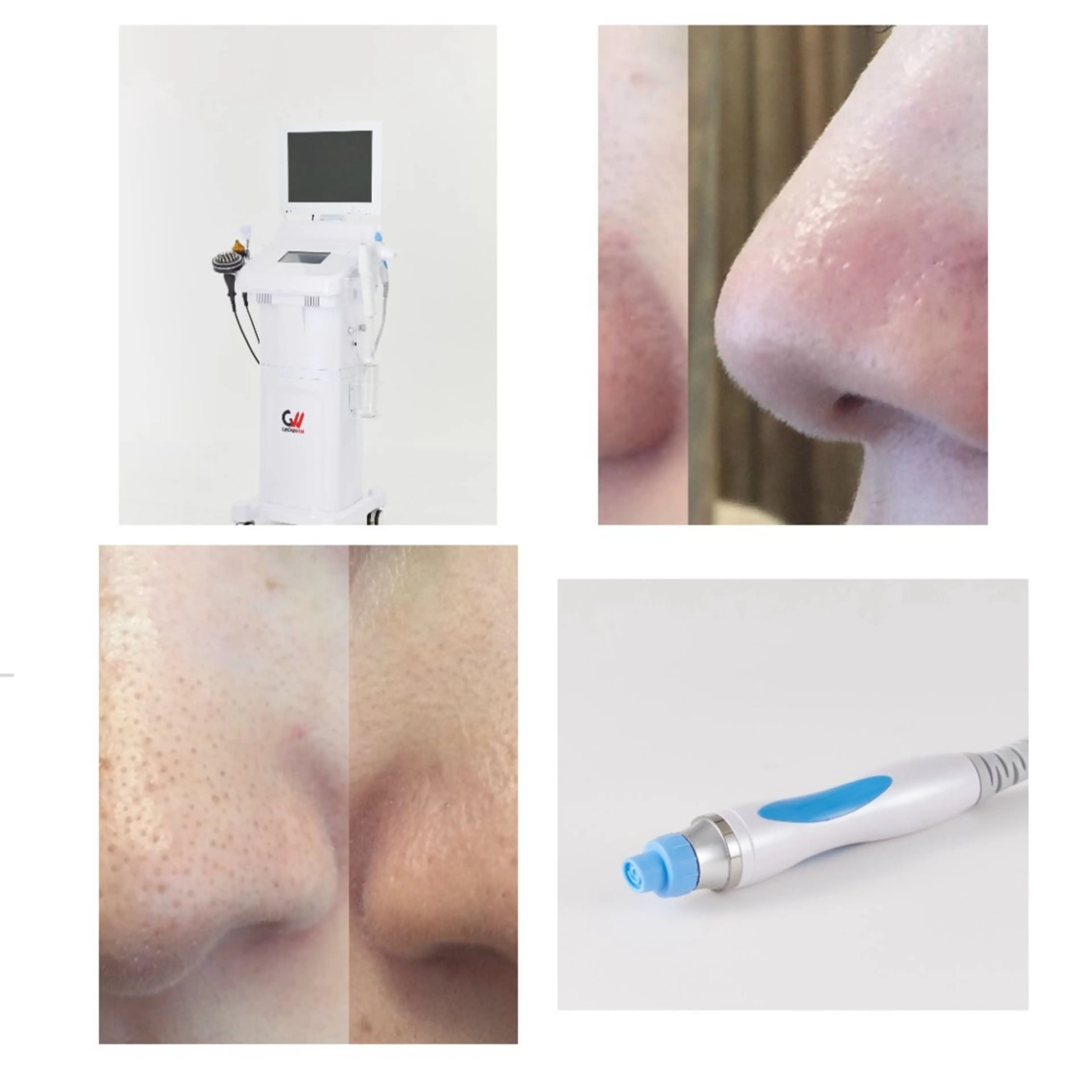 【吸引×導入×炭酸ガスパックでザラつき駆逐】うるつや毛穴洗浄全顔70分の写真