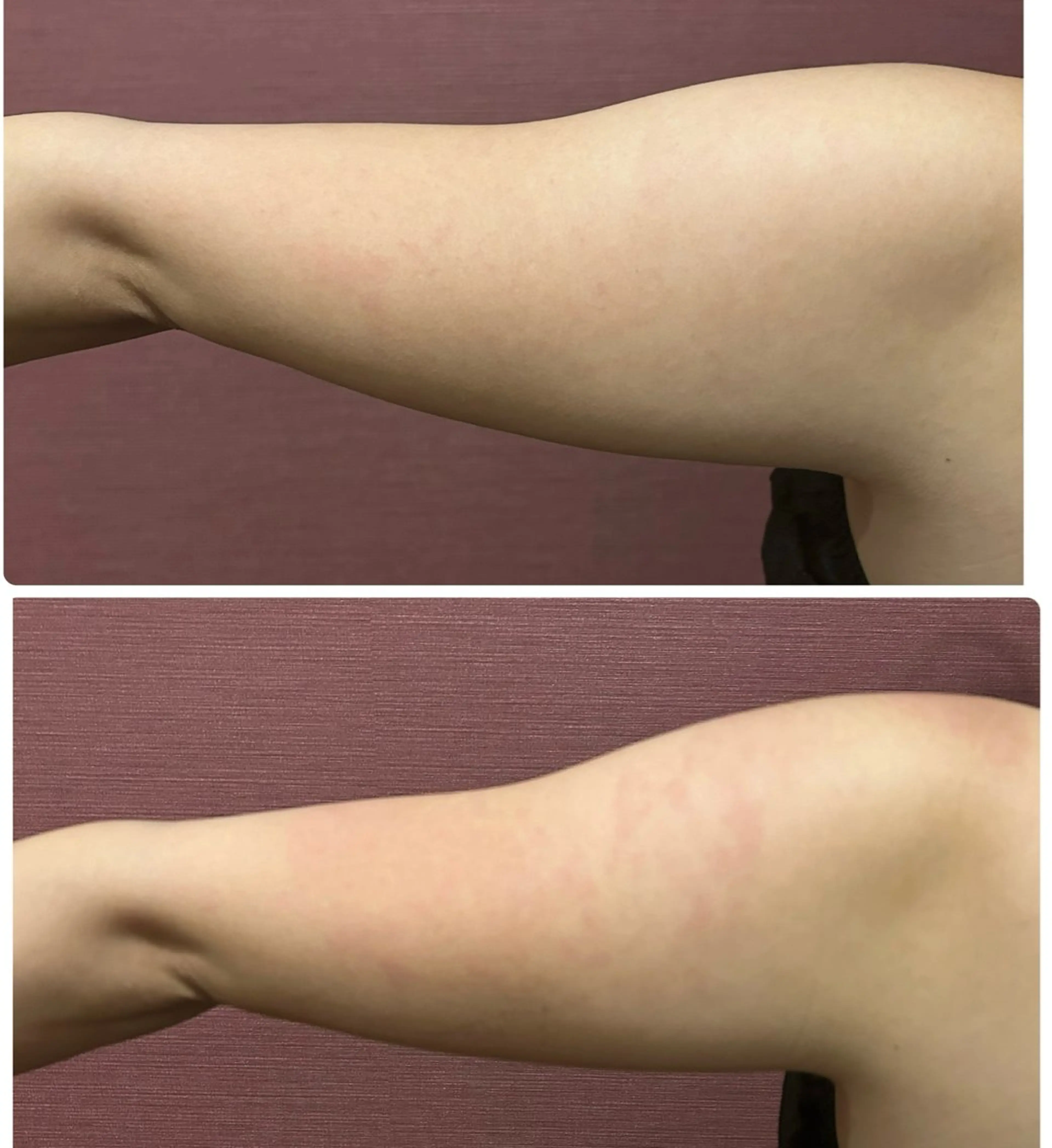 【痩身】二の腕すっきり！キャビテーション→ラジオ→吸引EMS  施術時間30分の写真