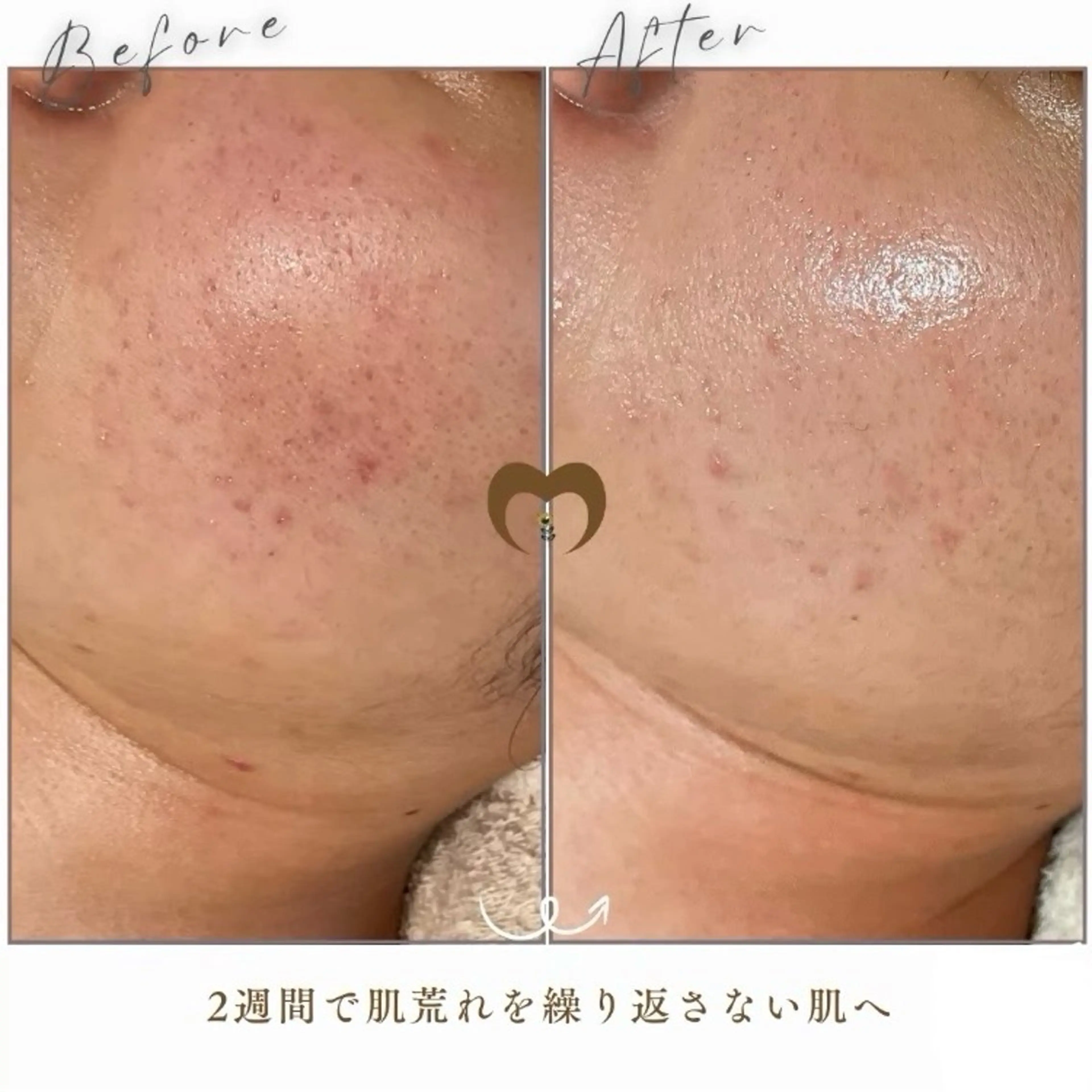 エステ リラク 繰り返すニキビ・毛穴 ✨つくば肌質改善専門のエステ・リラクイメージ