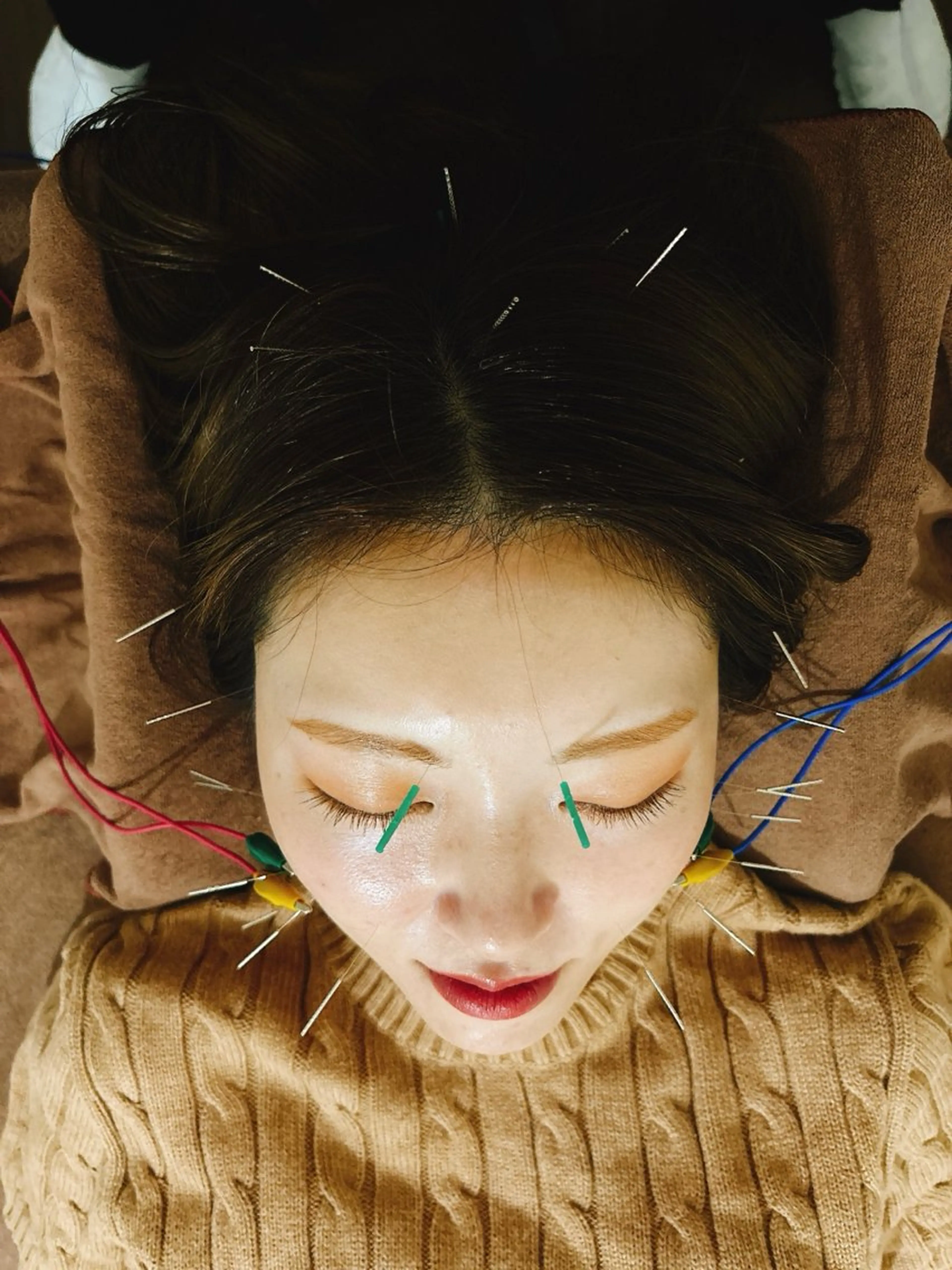 💆‍♀️美容鍼 🪡+ローラ+肩甲骨剥がし✨の写真