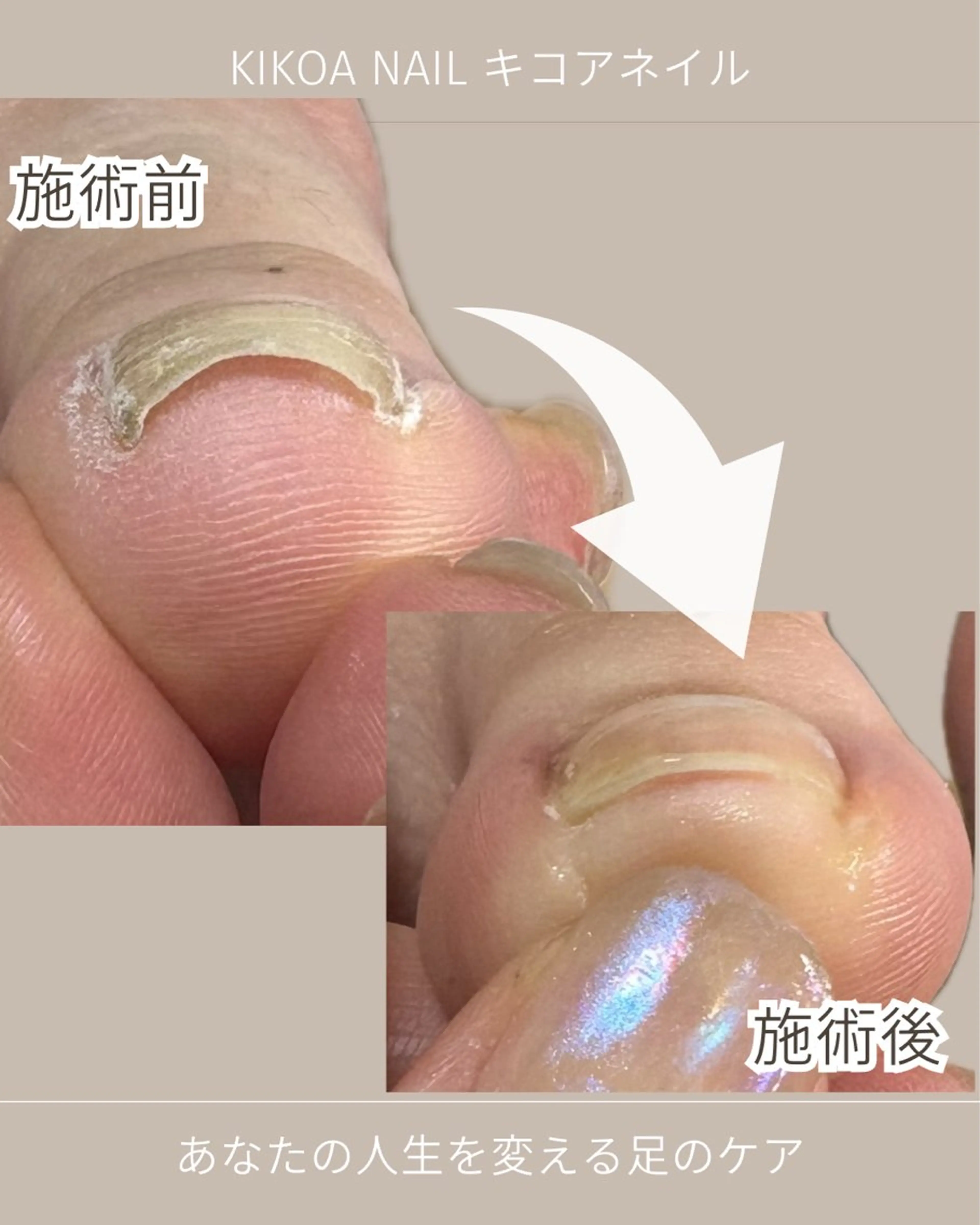 ネイル フットネイル KIKOA NAIL キコアネイルのネイルデザイン