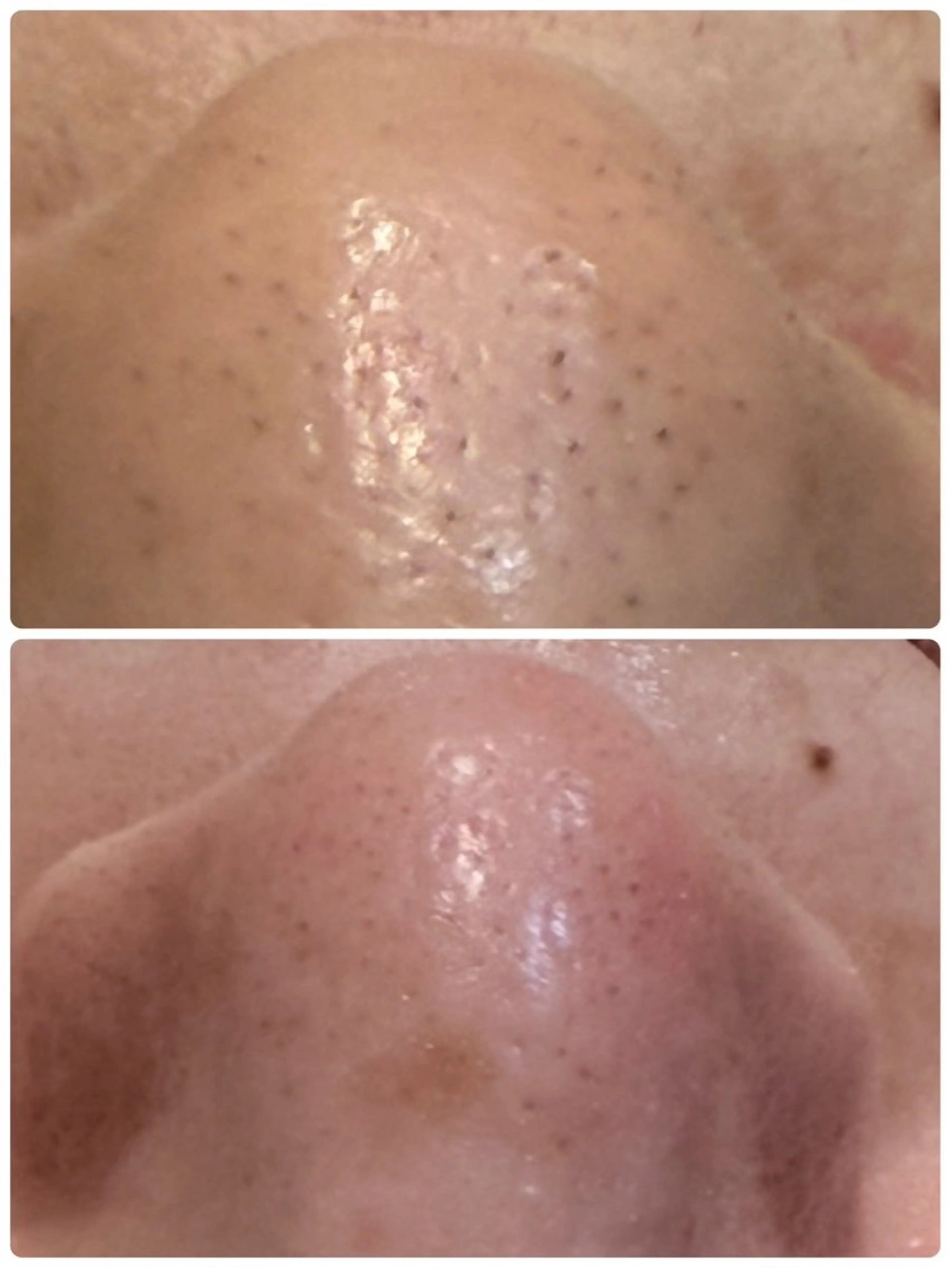 【鼻の毛穴洗浄】毛穴の詰まり/いちご鼻/毛穴の開き/ごわつきの写真