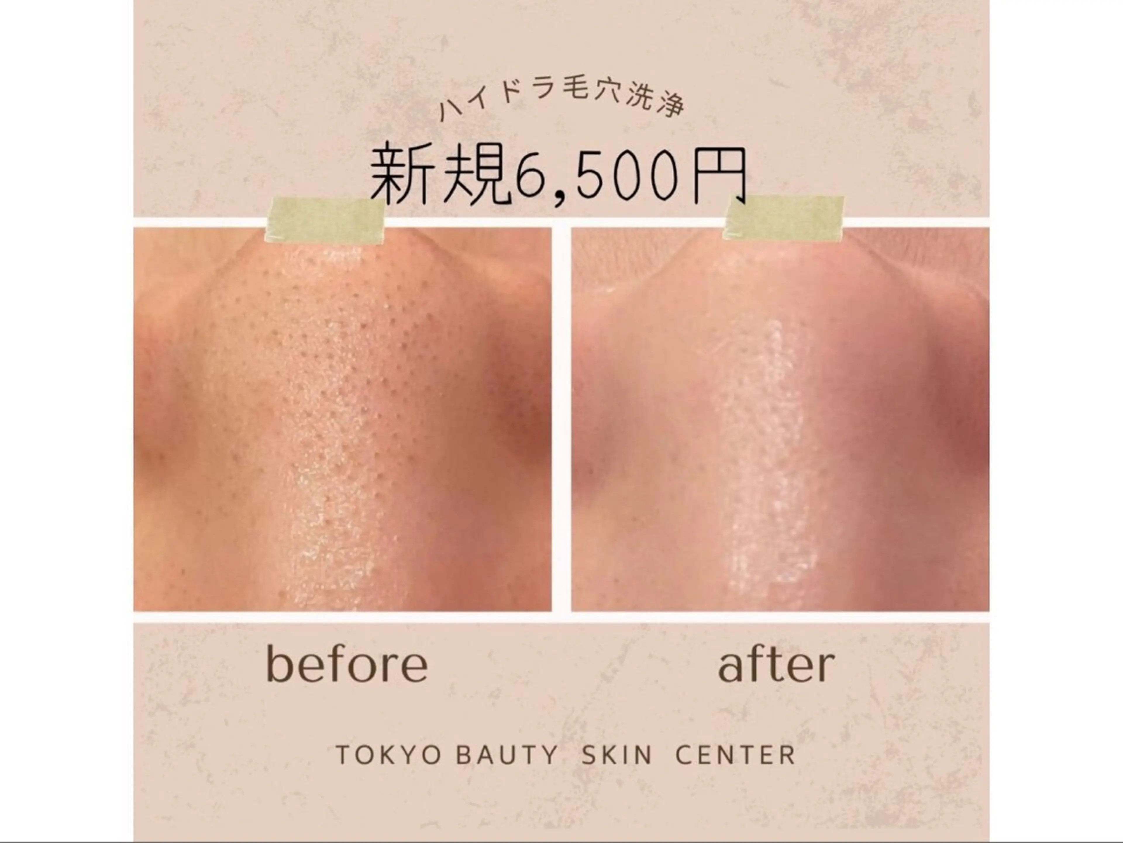 【毛穴の黒ずみ・角栓・いちご鼻が気になる方へ】ハイドラ毛穴洗浄フェイシャル＋PDRN美白美容液導入潤いあふれる水光肌への写真