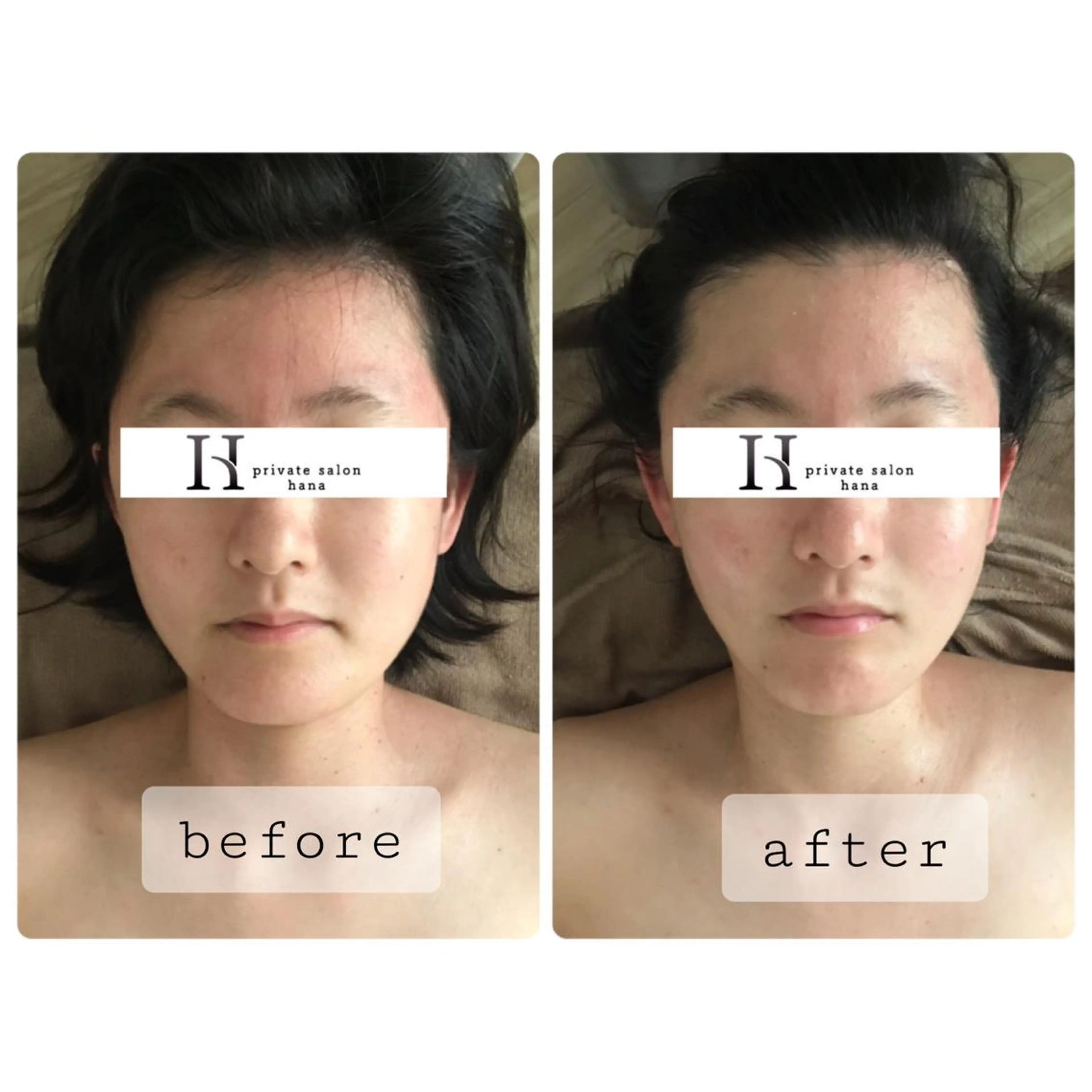 【たるみ撃退❗️小顔リフトケア60分】浮腫み老廃物を流し筋肉を引き上げリフトアップへ💆‍♀️の写真