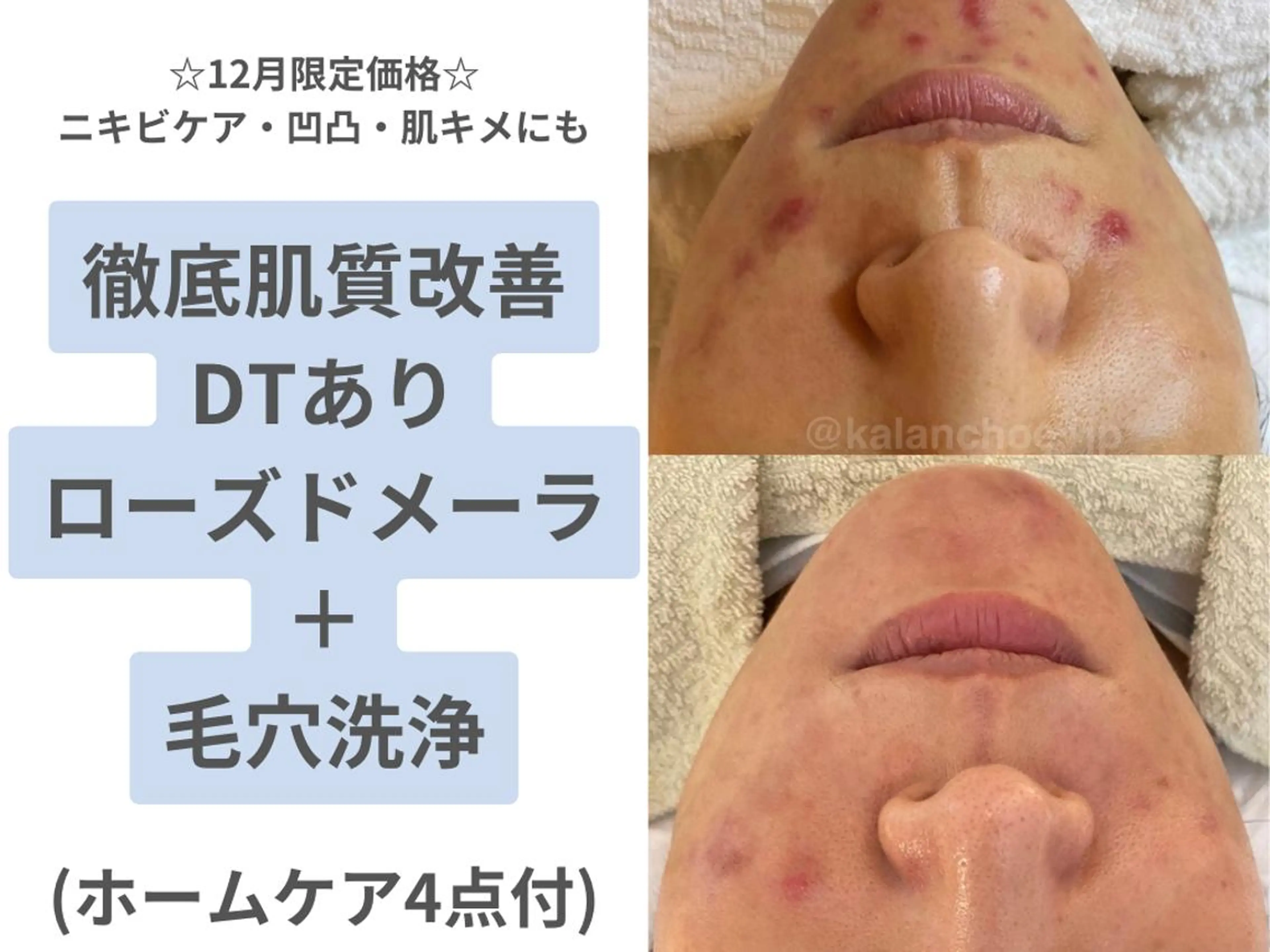 肌質改善 KALANCHOEのエステ・リラクイメージ