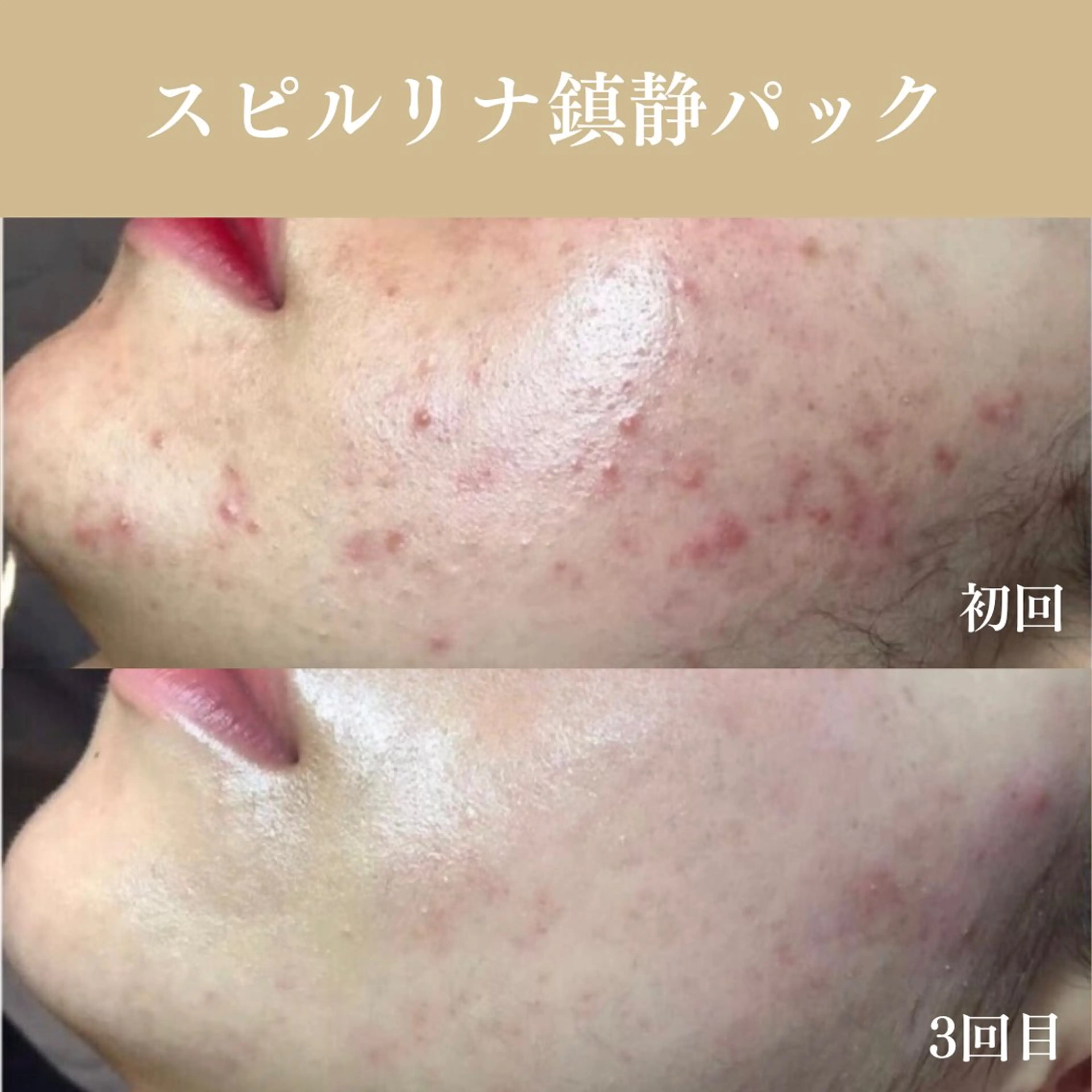 【ミニモ価格】肌荒れ鎮静ケアコース｜本気でニキビを治したい方や赤みが気になる方に🌿韓国式肌管理で肌トラブルを改善！の写真