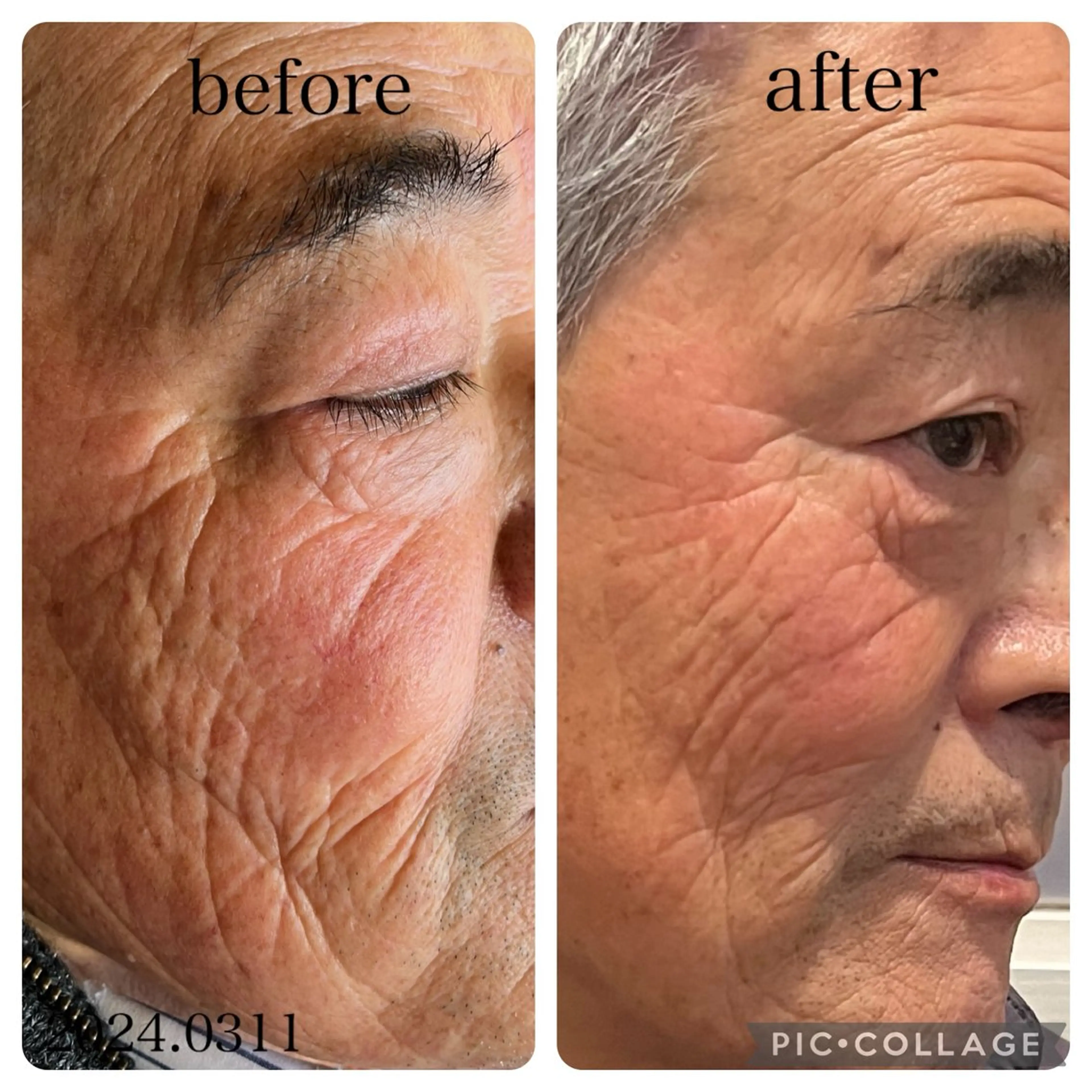 最新ハーブピーリング+保湿&鎮静パックの写真