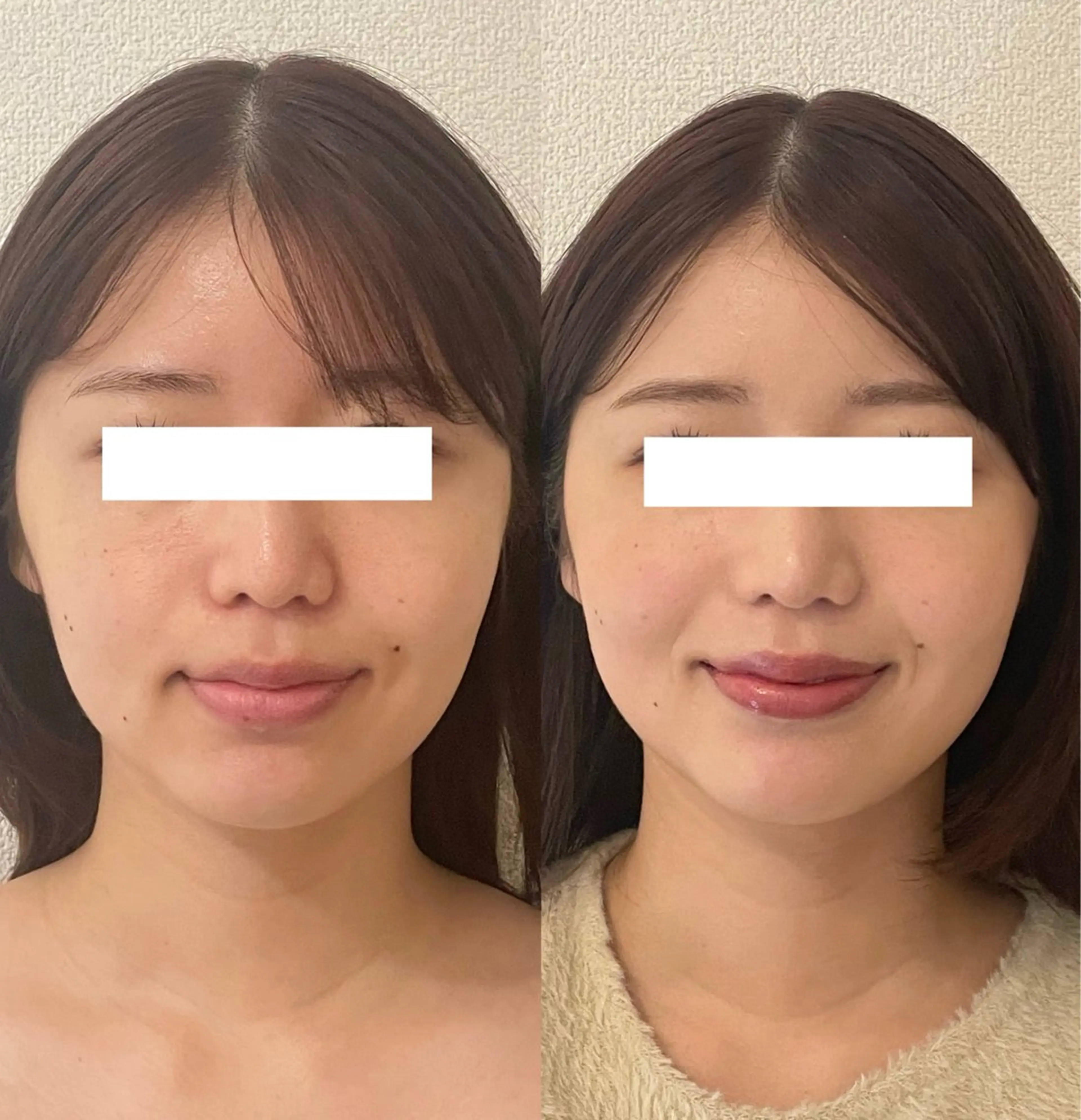 小顔/たるみ/黒ずみ除去専門サロン/SONA 大和西大寺店所属・【小顔痩身専門看護師 サロンSONA】のエステ・リラクイメージ