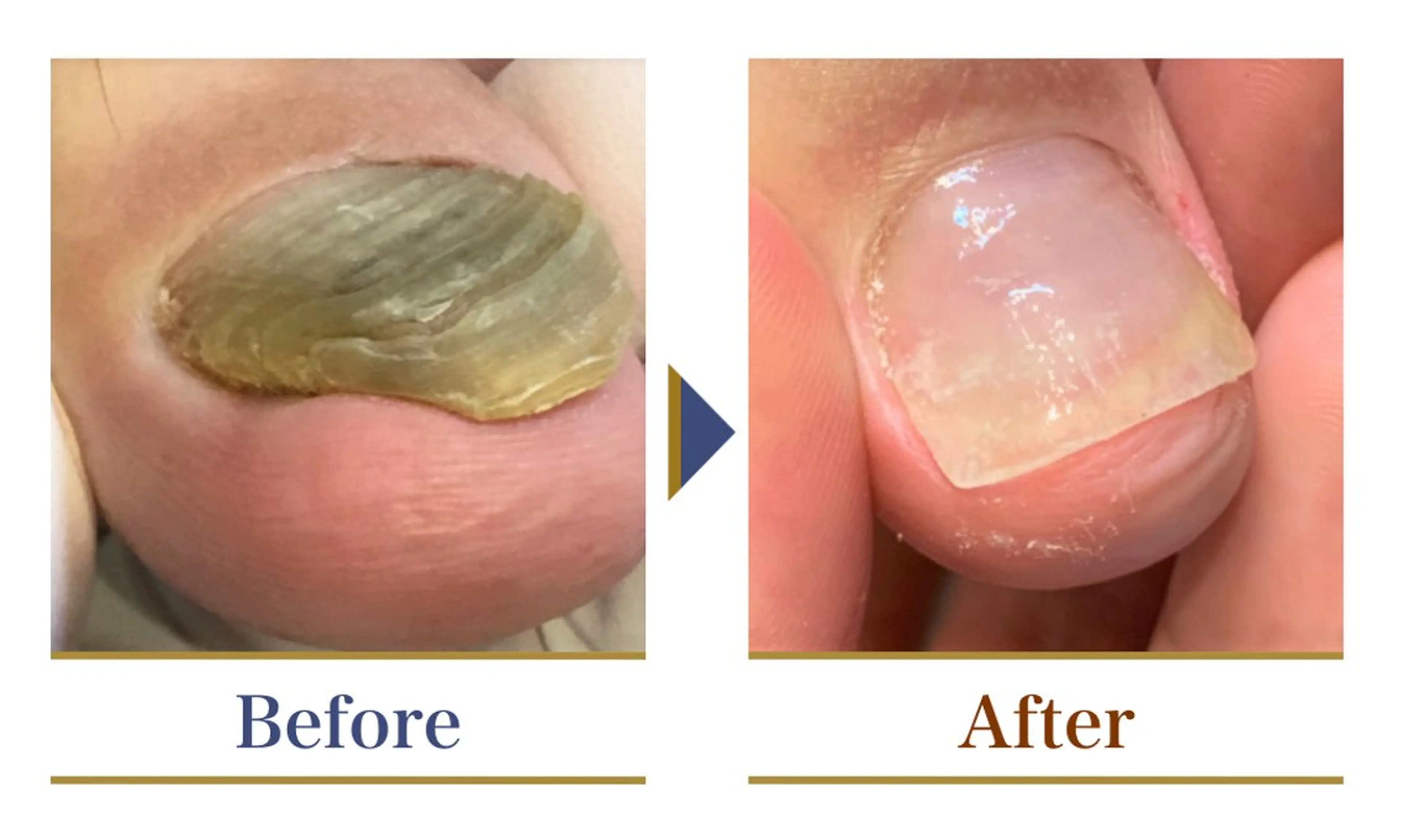 限定10名様★「分厚い爪」「変形爪」提示条件:お写真の撮影・口コミ投稿にご協力頂ける方※2爪からは通常価格の写真