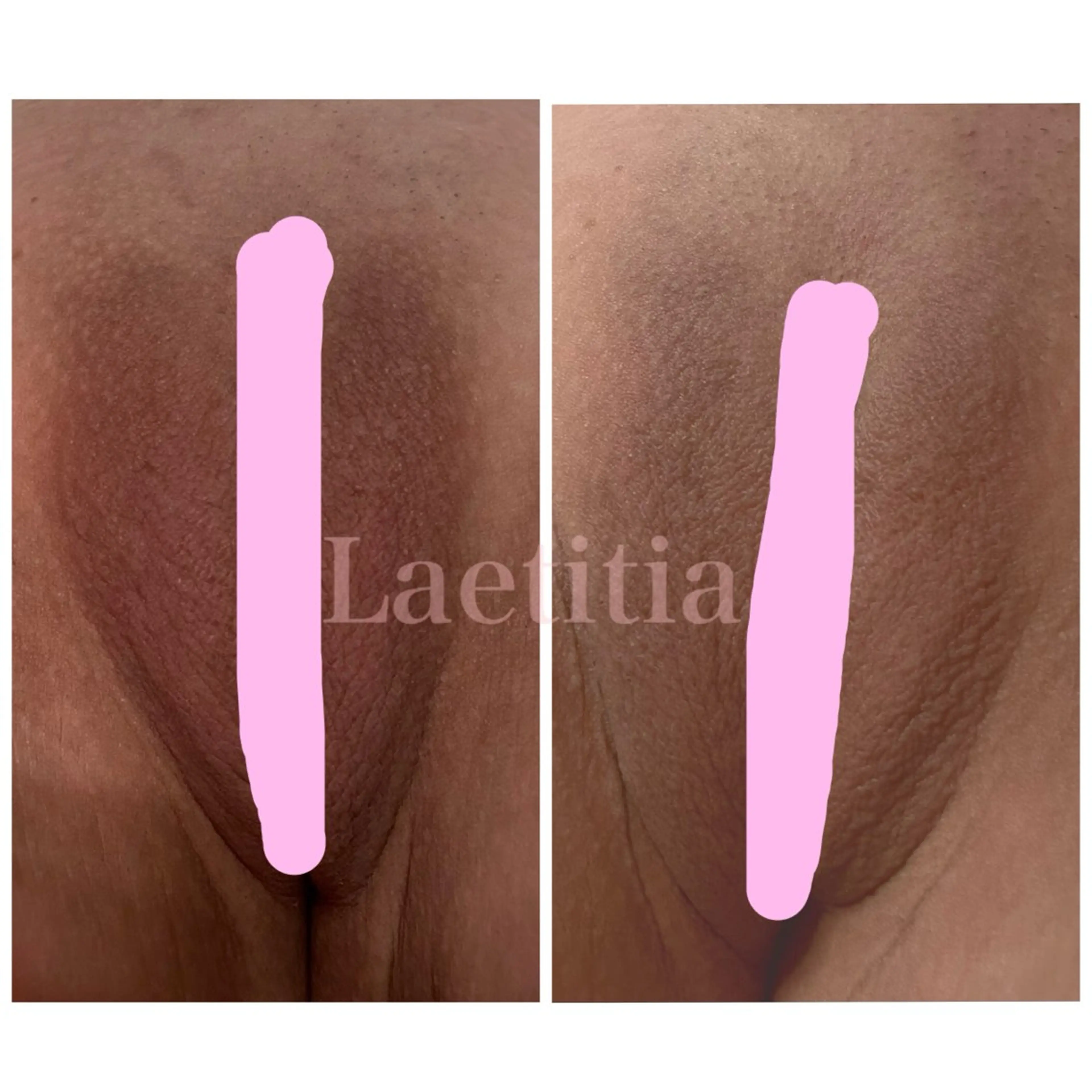 【大変好評の為４月末まで延長決定！特別キャンペーン価格✨】ローマピンク🌸『Iライン』の写真