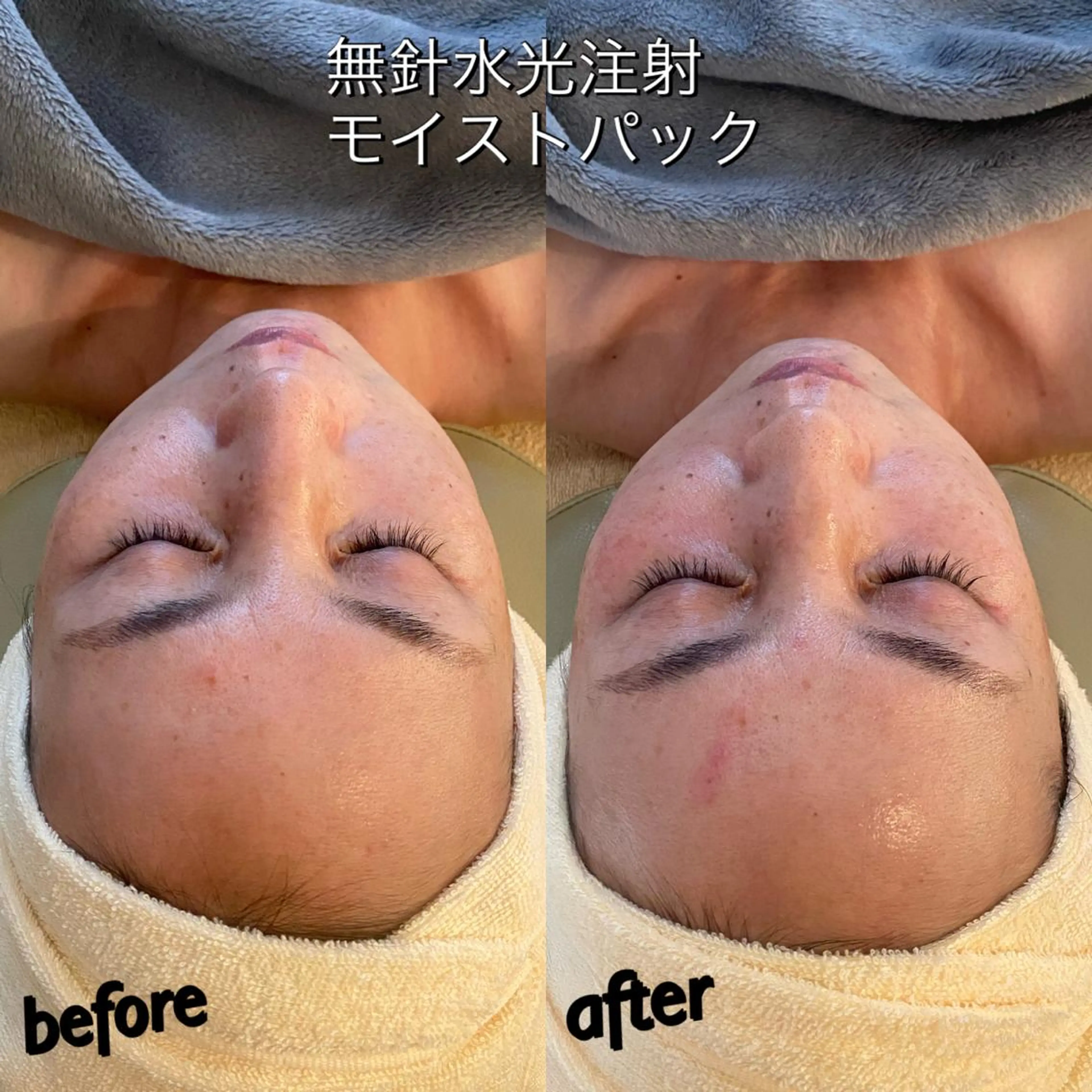 うなじ脱毛/美肌脱毛 LABELのエステ・リラクイメージ