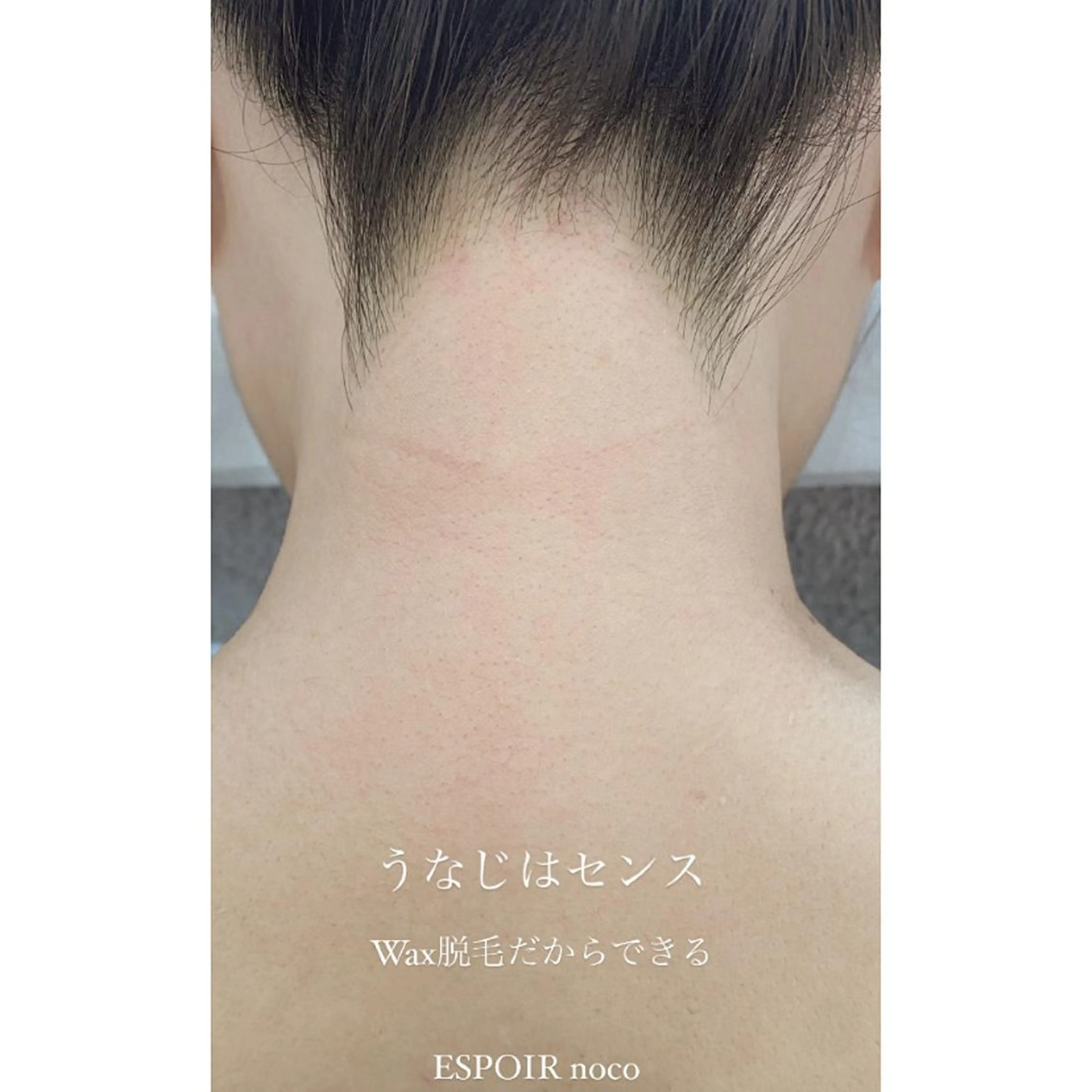1ヶ月毛の生えないうなじ❗️本日🈳🈶うなじWax＋光脱毛🌈　ダブル脱毛でうなじ美人に💛鎮静パック付きの写真