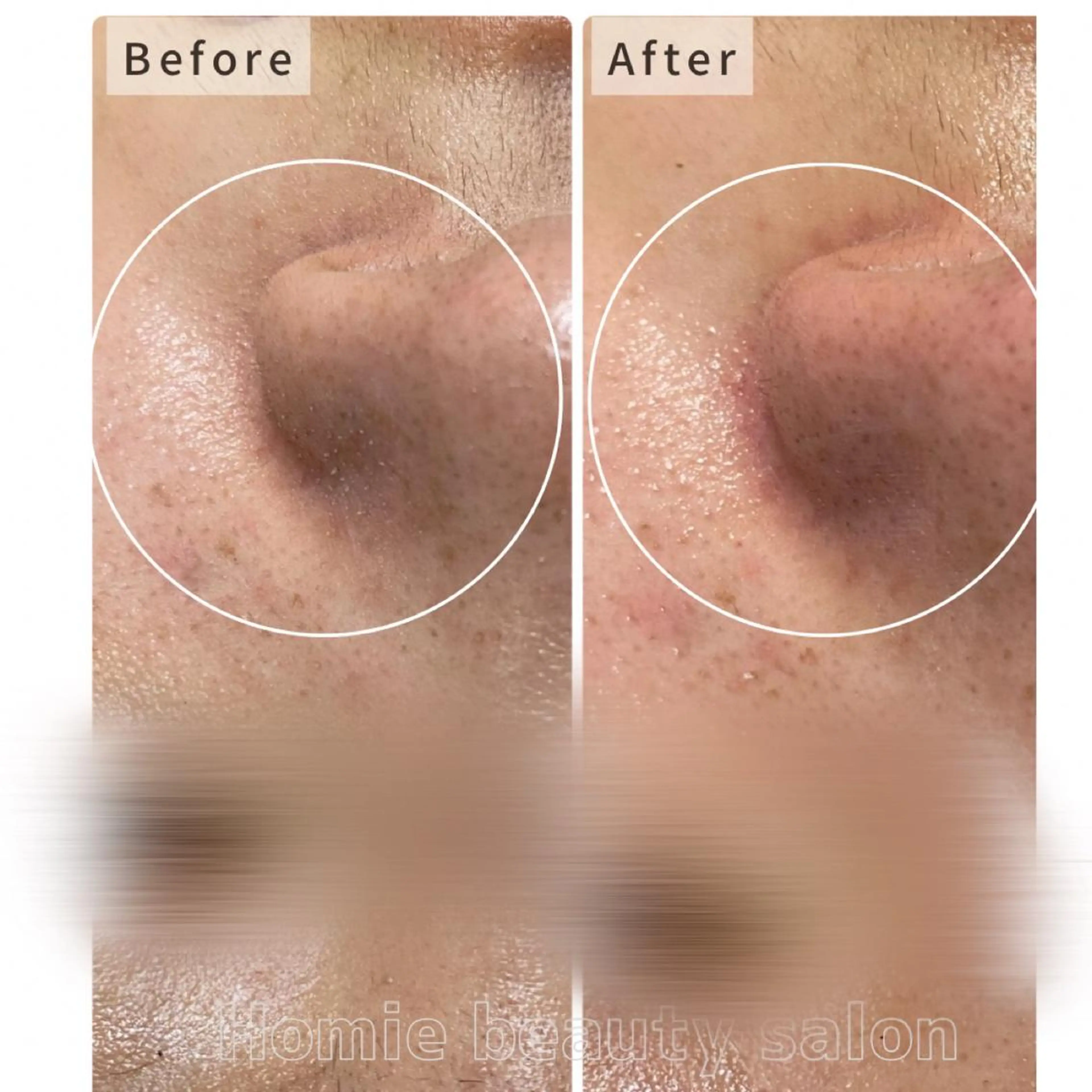 エステ ハーブピーリング🌹 Homieのエステ・リラクイメージ