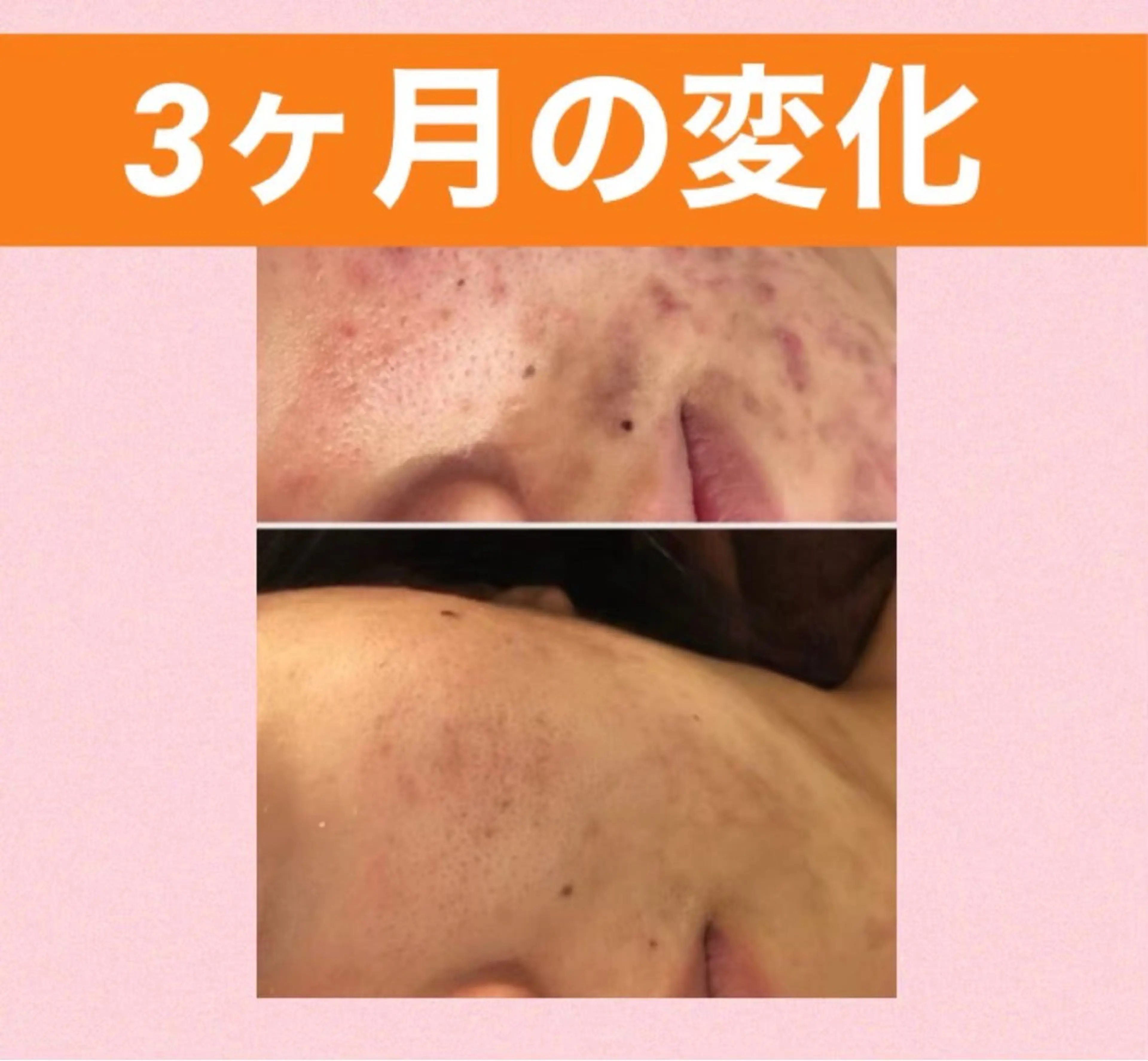 メンズ キッズ ニキビ専門 肌トラブル解消サロンのエステ・リラクイメージ