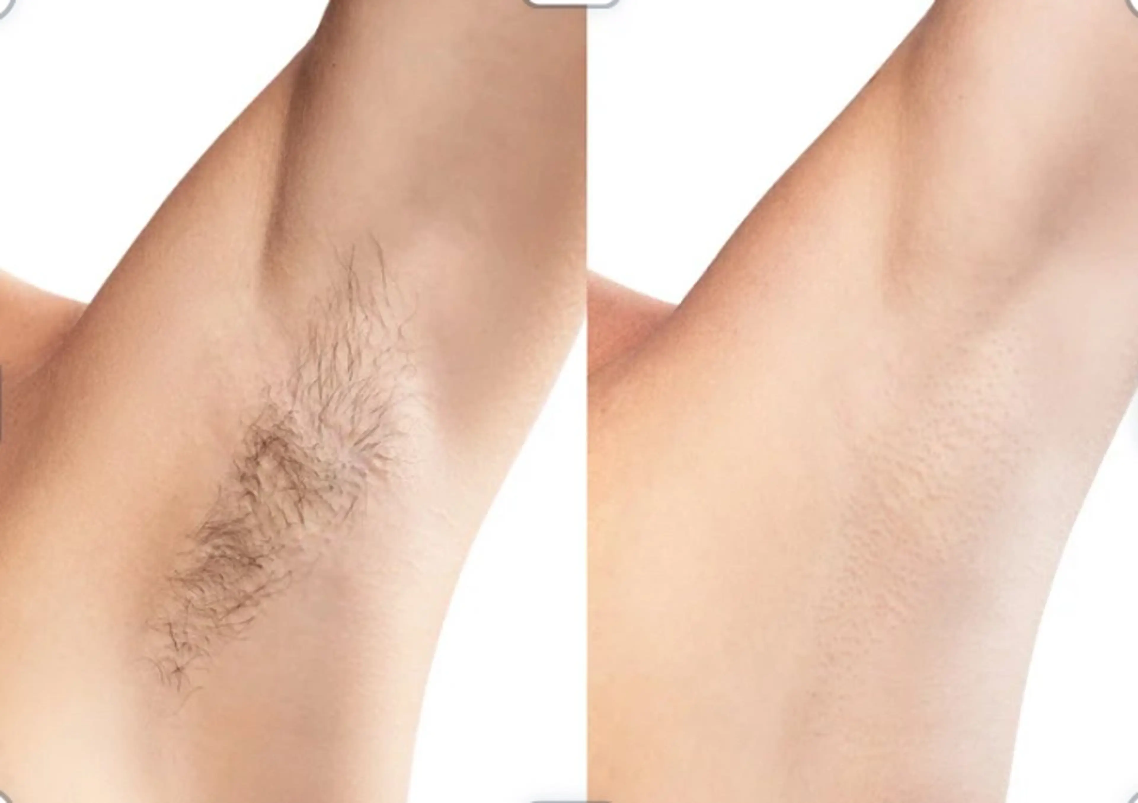 ワキ脱毛– 学生にも安心、安全で効果実感!の写真