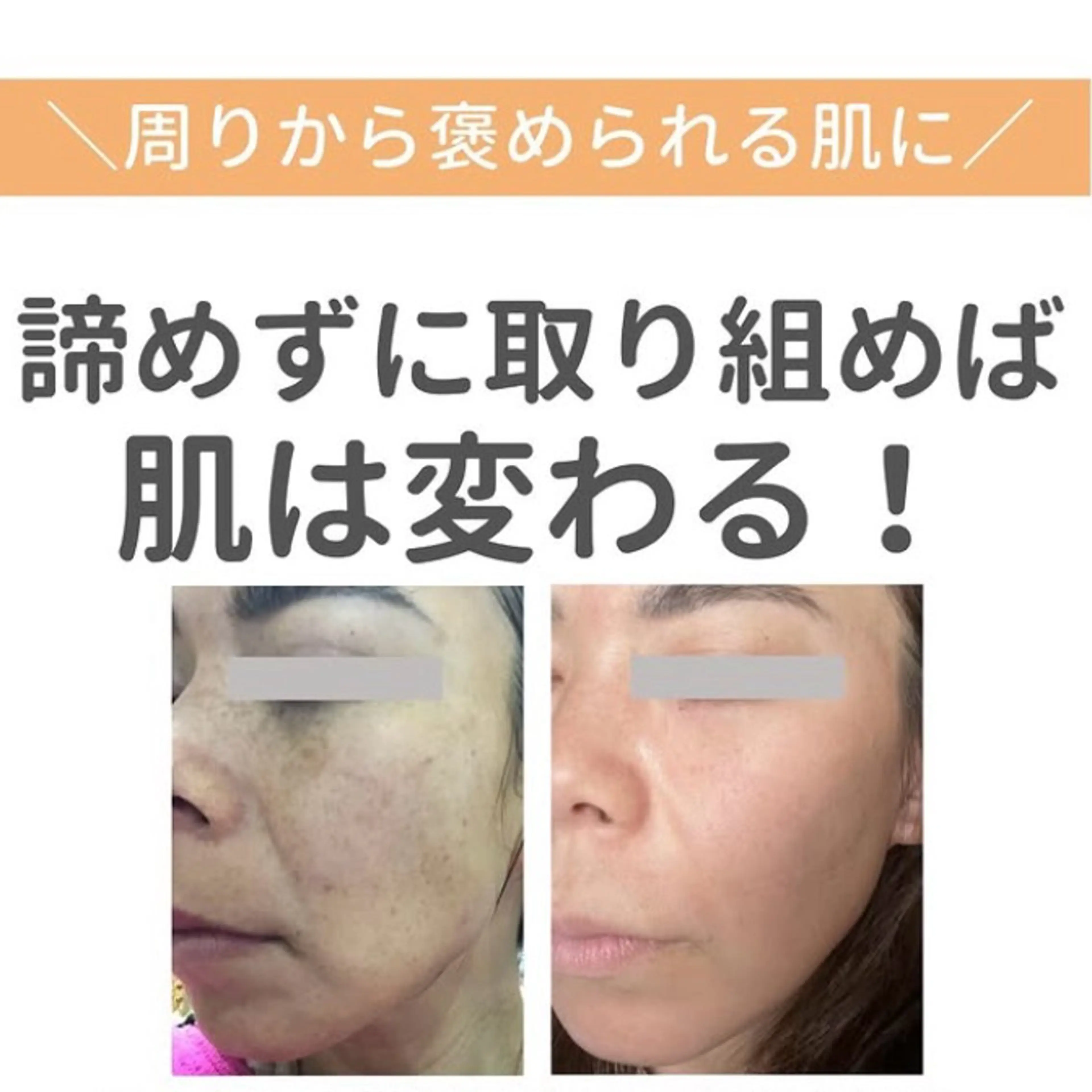 【たるみ・たるみ毛穴ケア】ラジオ波&人幹細胞培養液のポレーションでたるみに革命!!最新ケアで年齢サインを徹底リセット。の写真