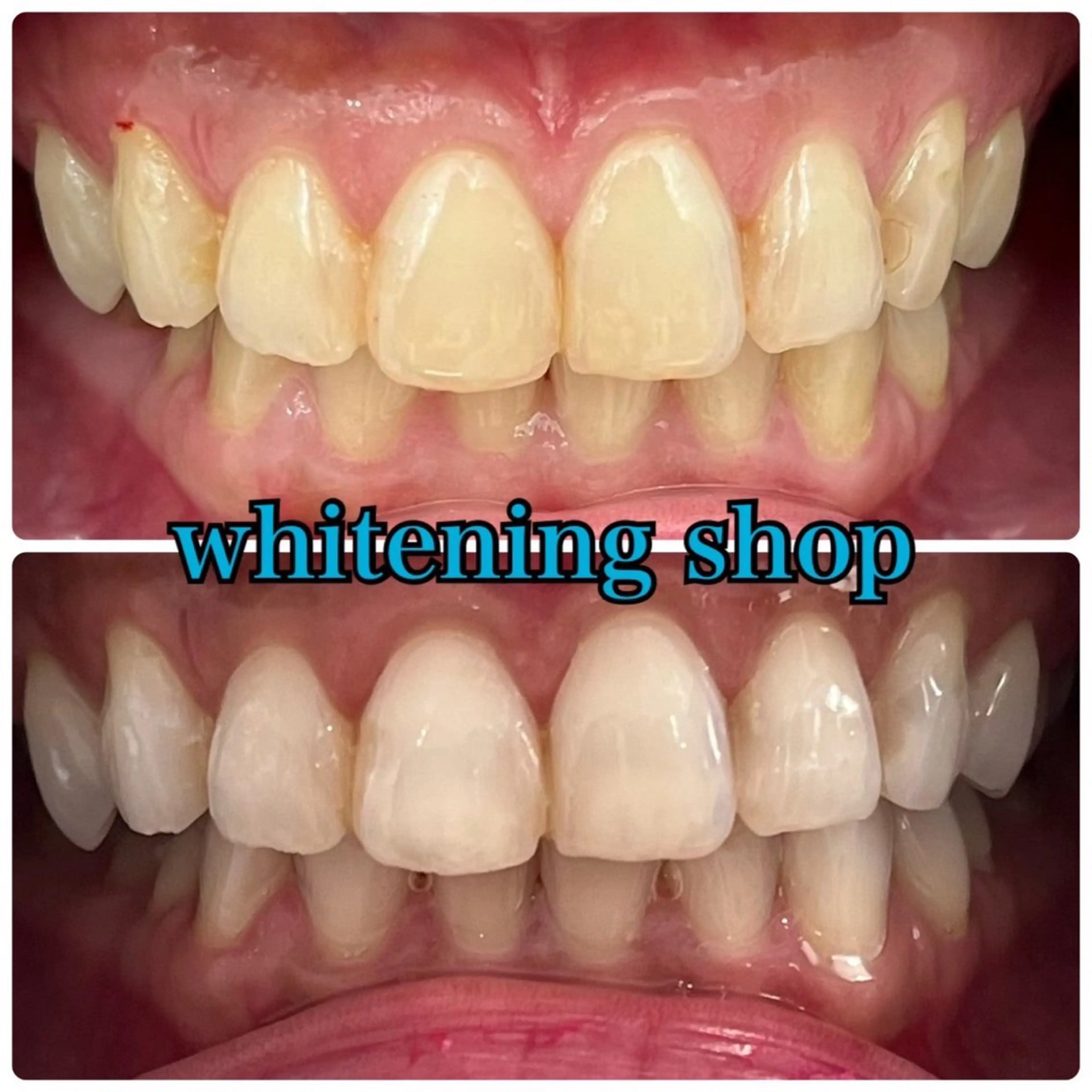 【プレミアムコース✨】家族、友達、恋人とシェア可能！！セルフホワイトニング20分照射×50回の写真